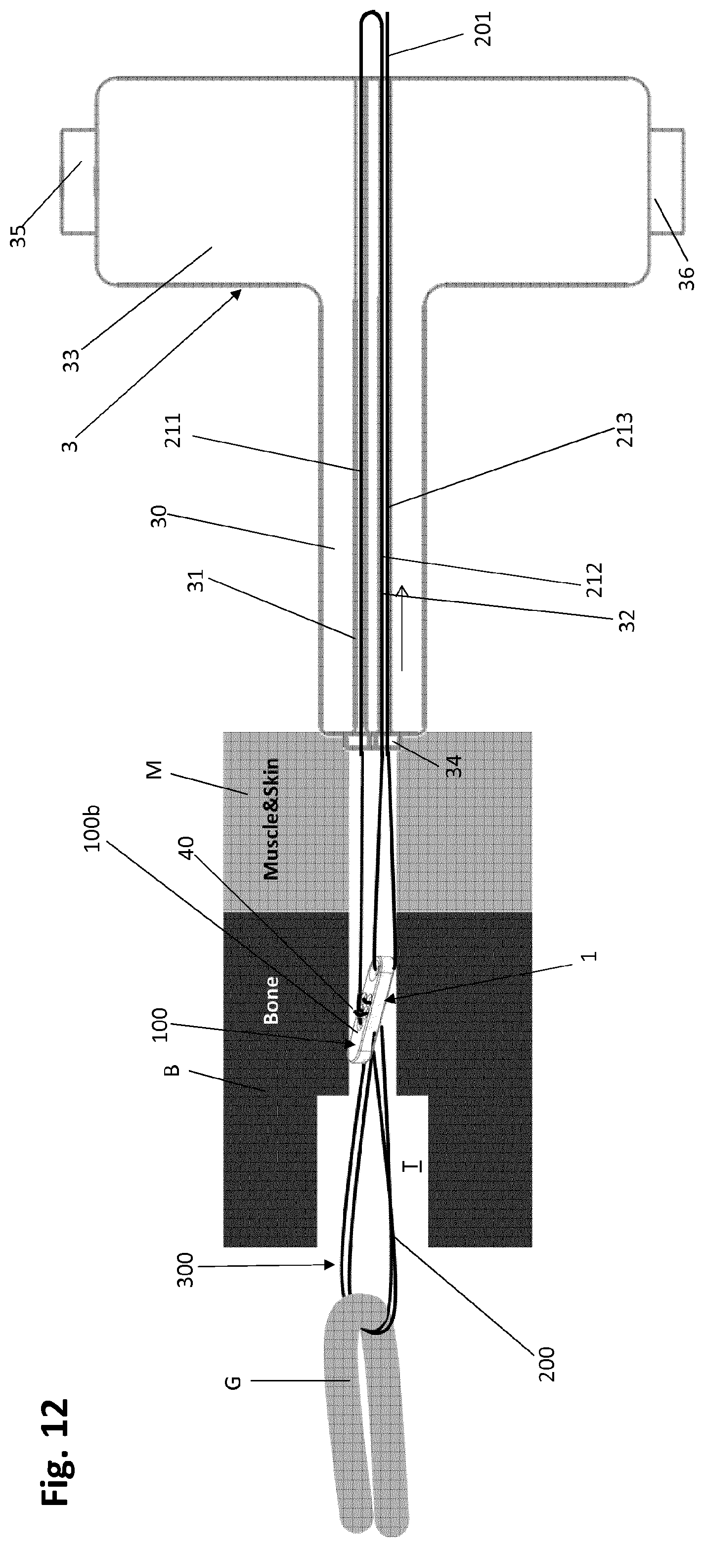 Patent US12318083 Figure 14 – Single strand self-locking suspension device for medical use