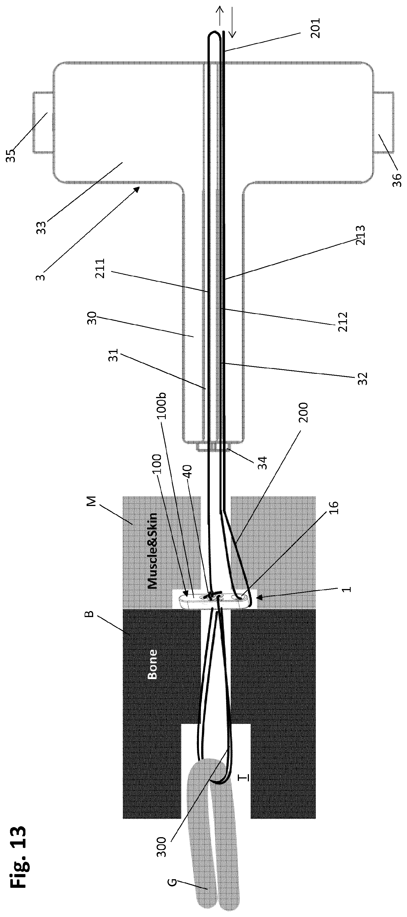 Patent US12318083 Figure 15 – Single strand self-locking suspension device for medical use