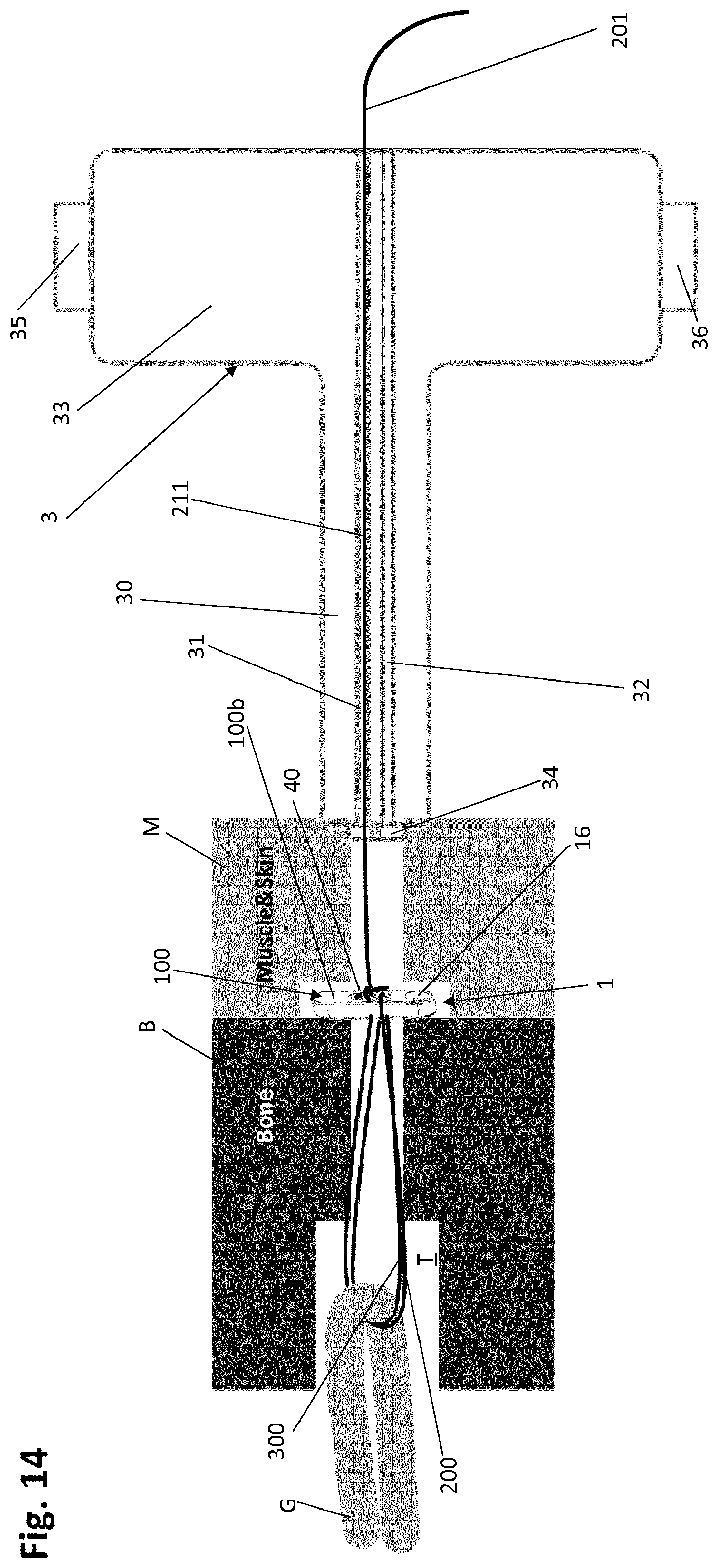 Patent US12318083 Figure 16 – Single strand self-locking suspension device for medical use