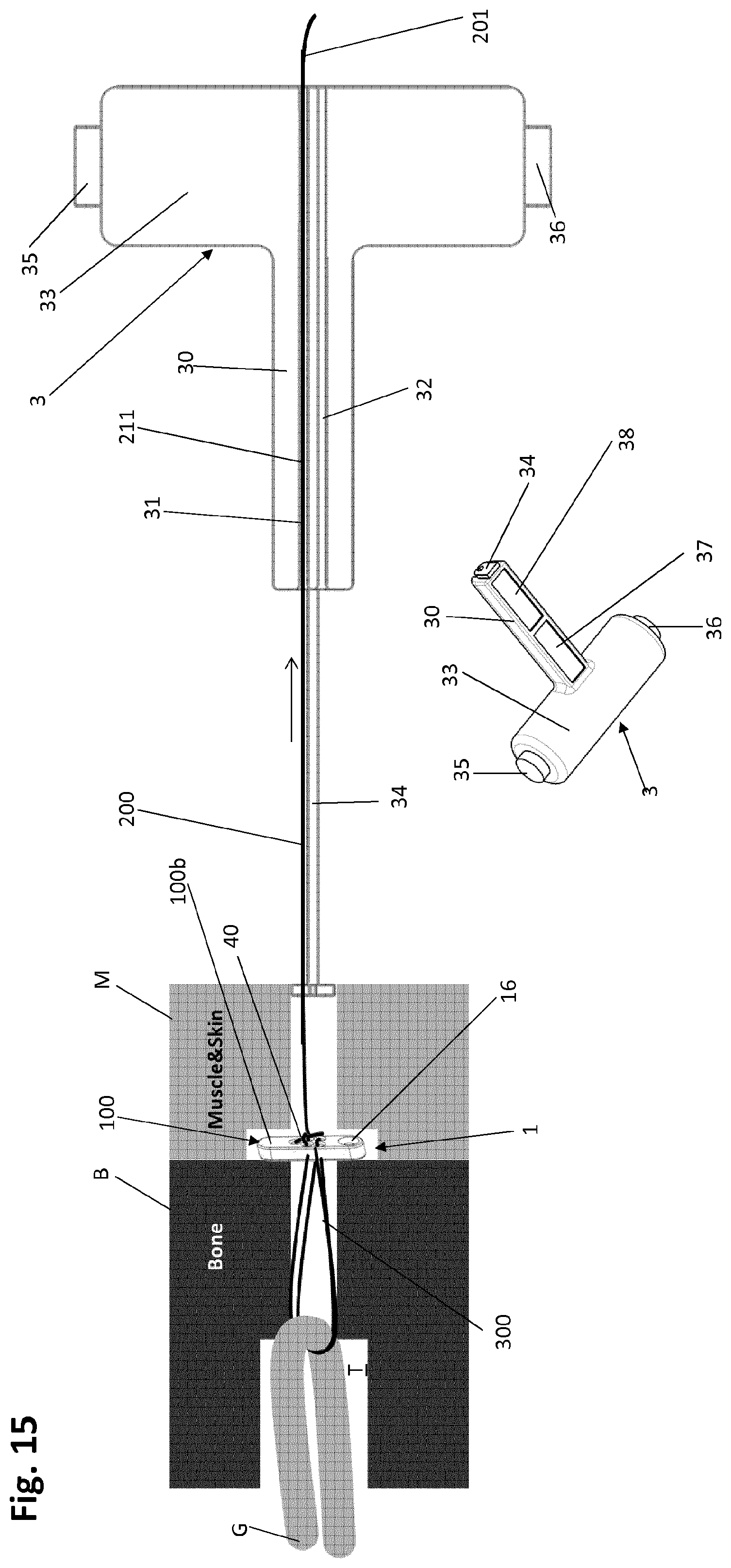 Patent US12318083 Figure 17 – Single strand self-locking suspension device for medical use