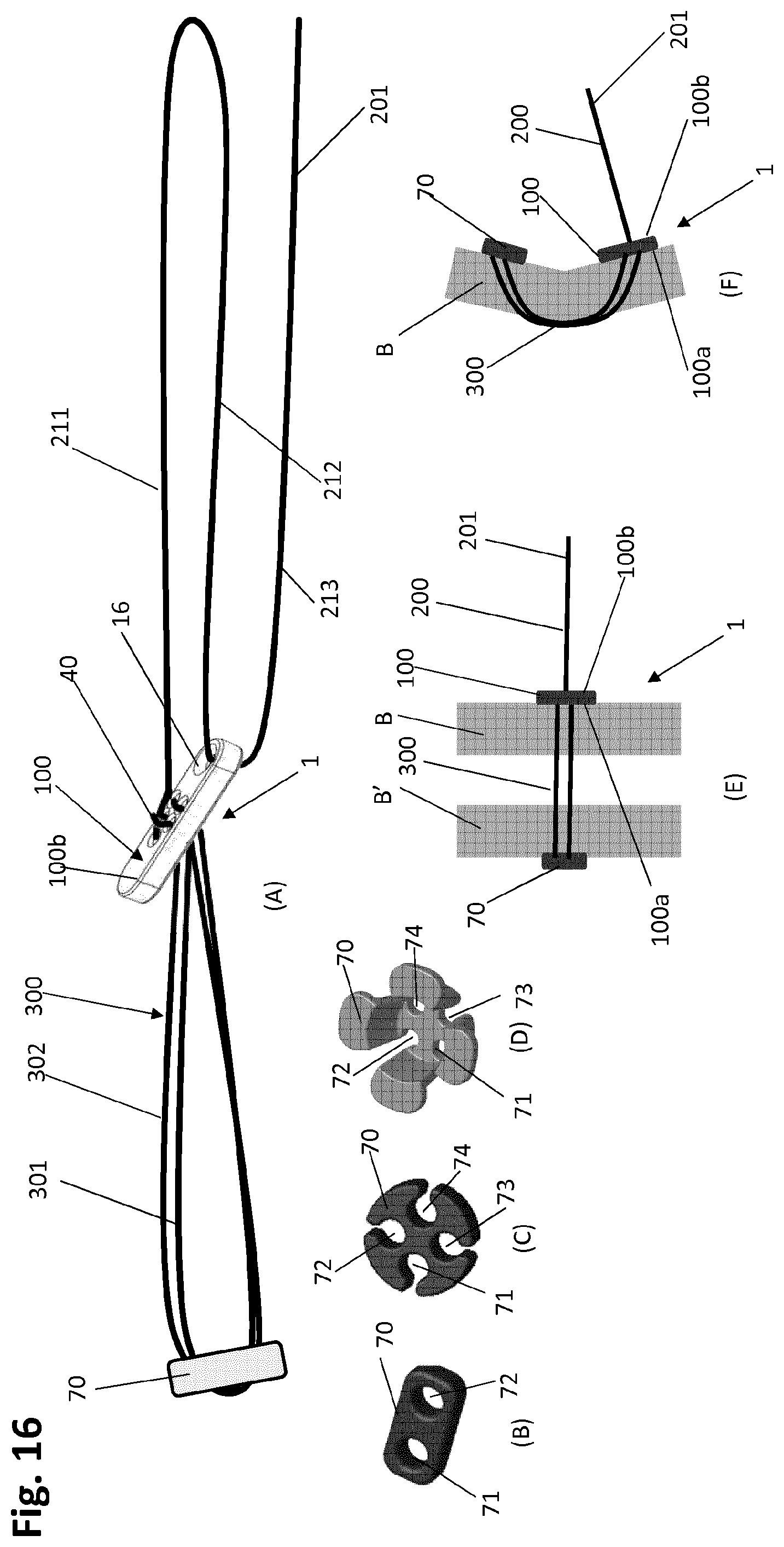 Patent US12318083 Figure 18 – Single strand self-locking suspension device for medical use