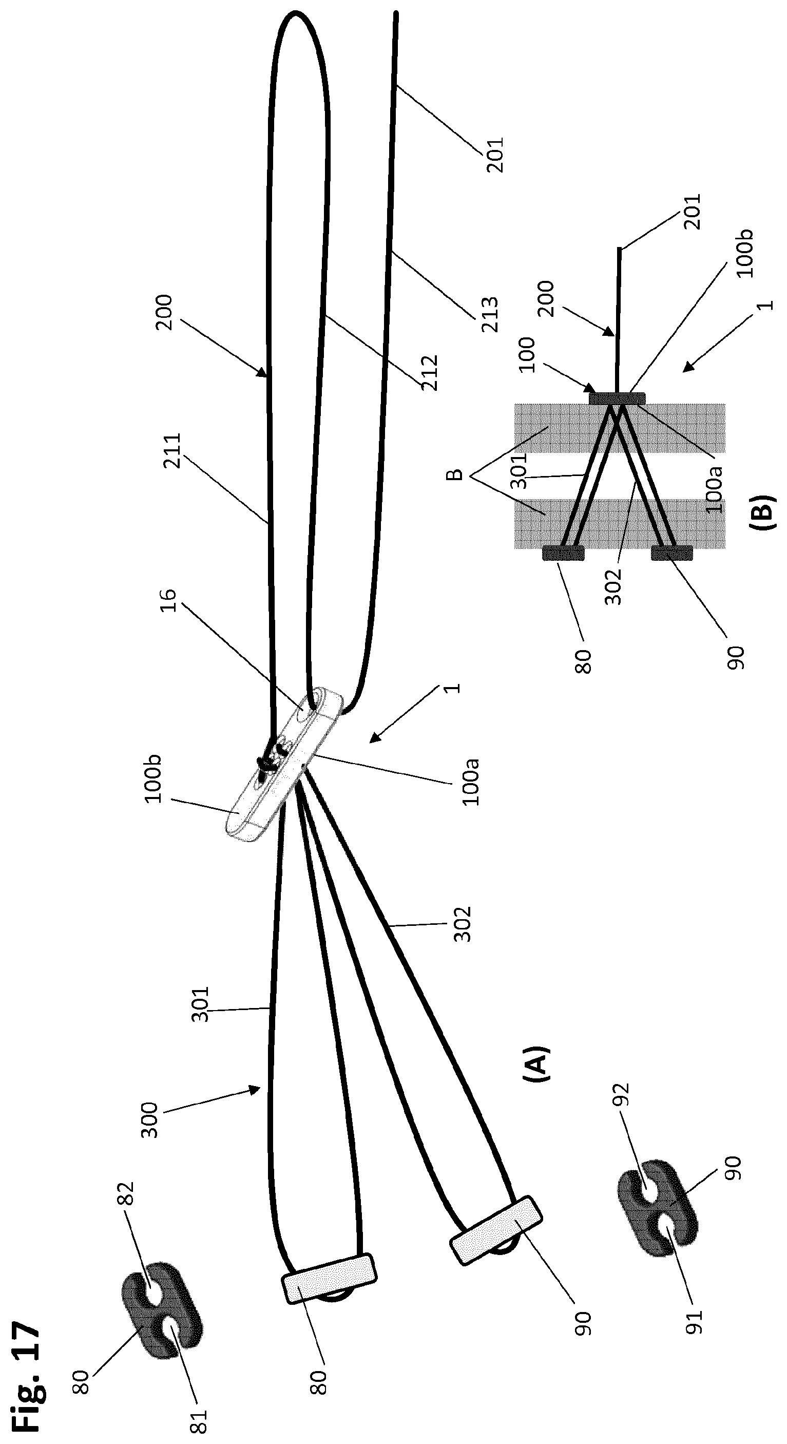 Patent US12318083 Figure 19 – Single strand self-locking suspension device for medical use