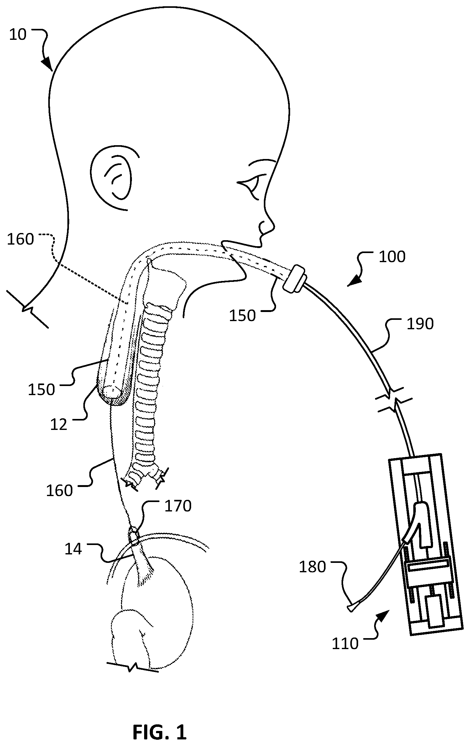 Patent US12318084 Figure 1 – Medical devices and methods for body conduit lengthening and anastomosis formation