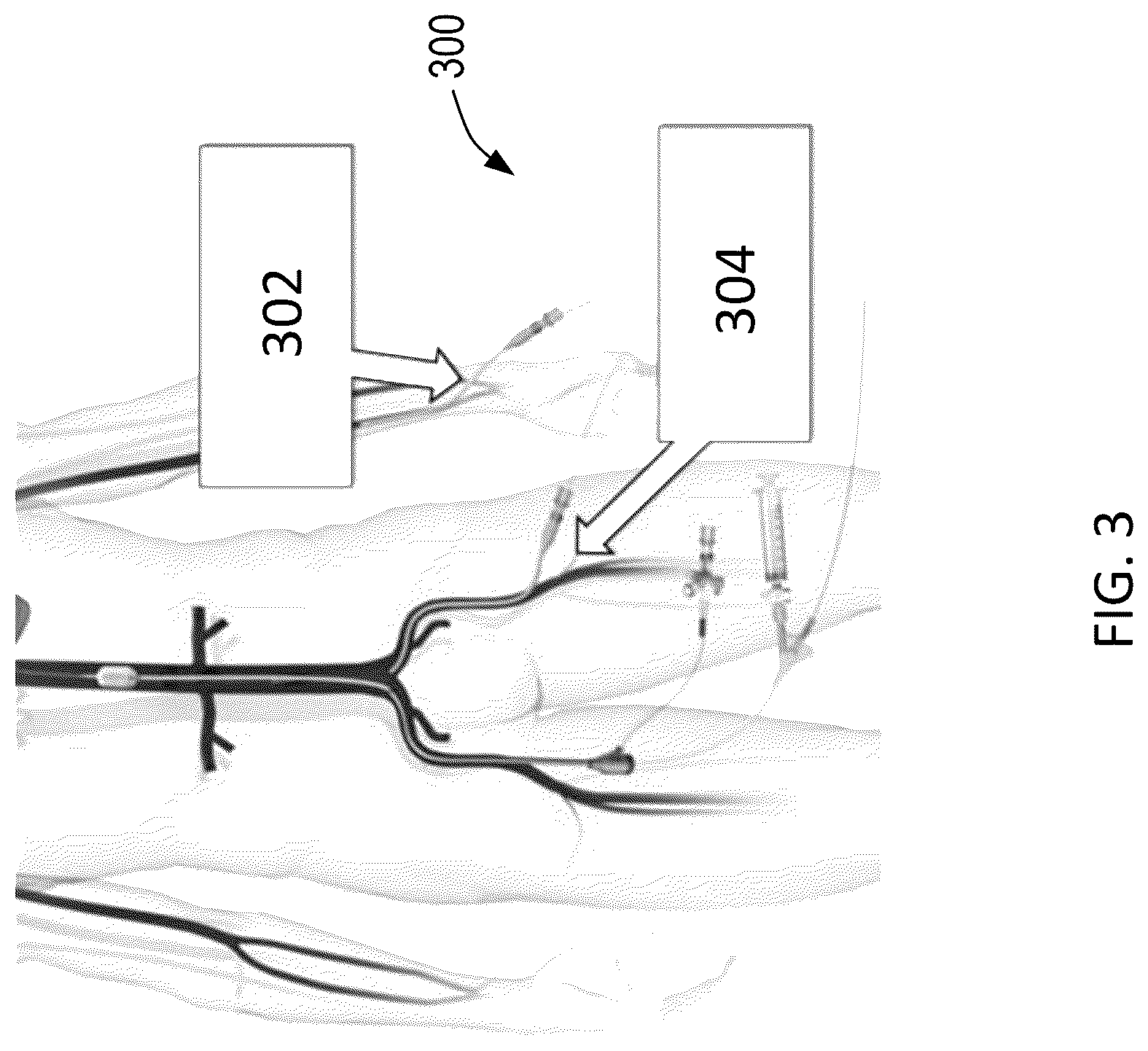 Patent US12318090 Figure 3 – Aortic flow meter and pump for partial-aortic occlusion