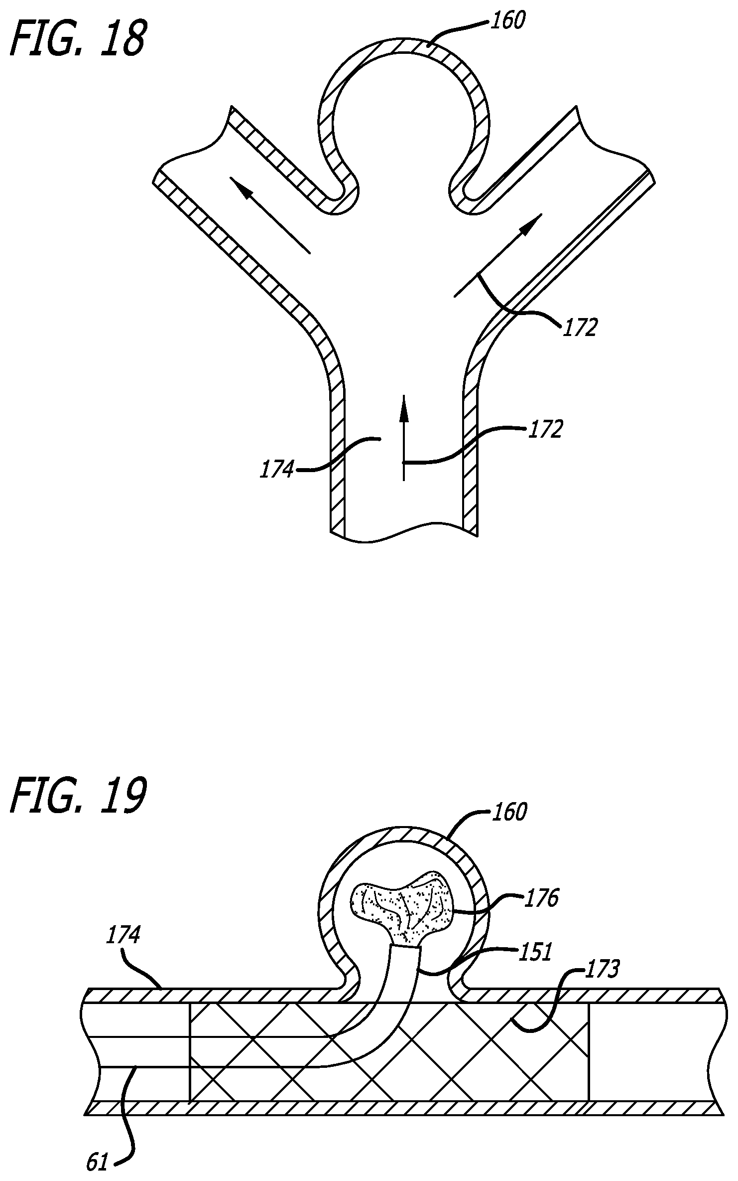 Patent US12318091 Figure 13 – Filamentary devices for treatment of vascular defects