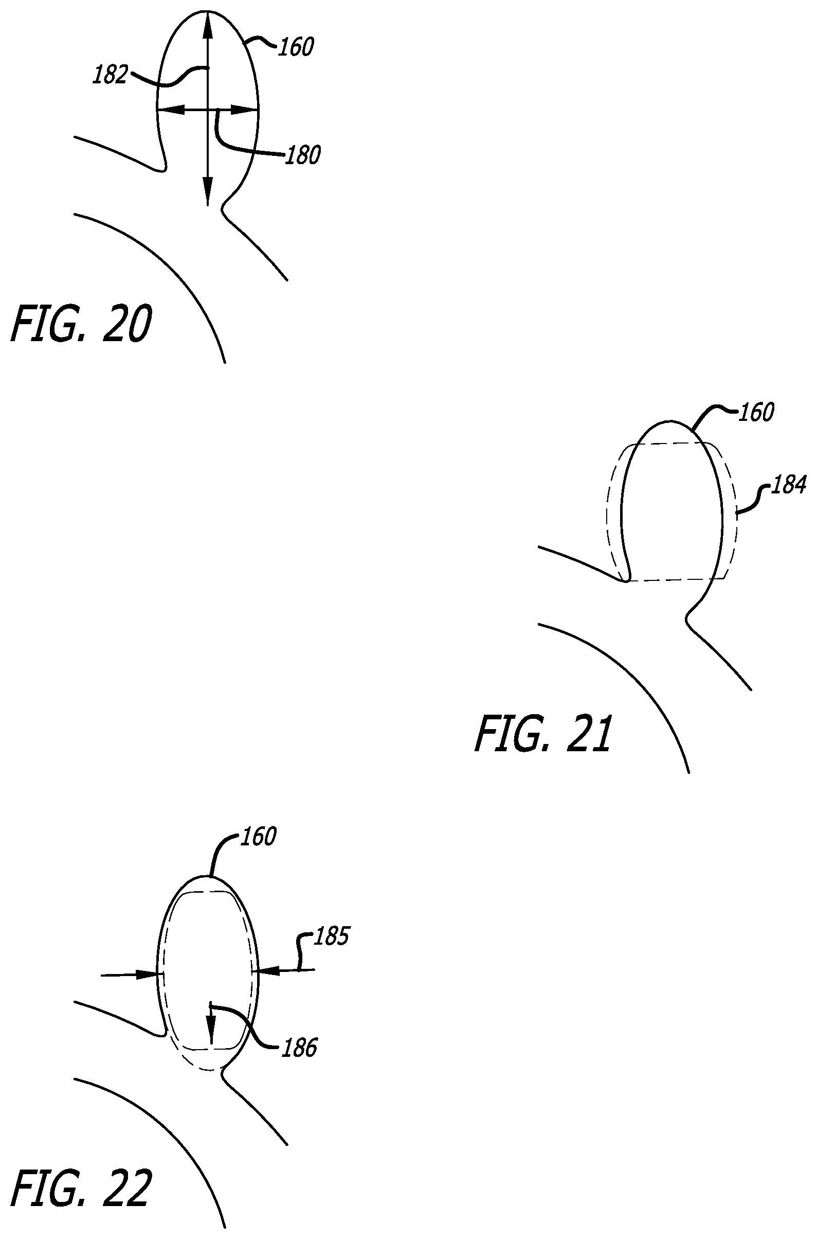 Patent US12318091 Figure 14 – Filamentary devices for treatment of vascular defects