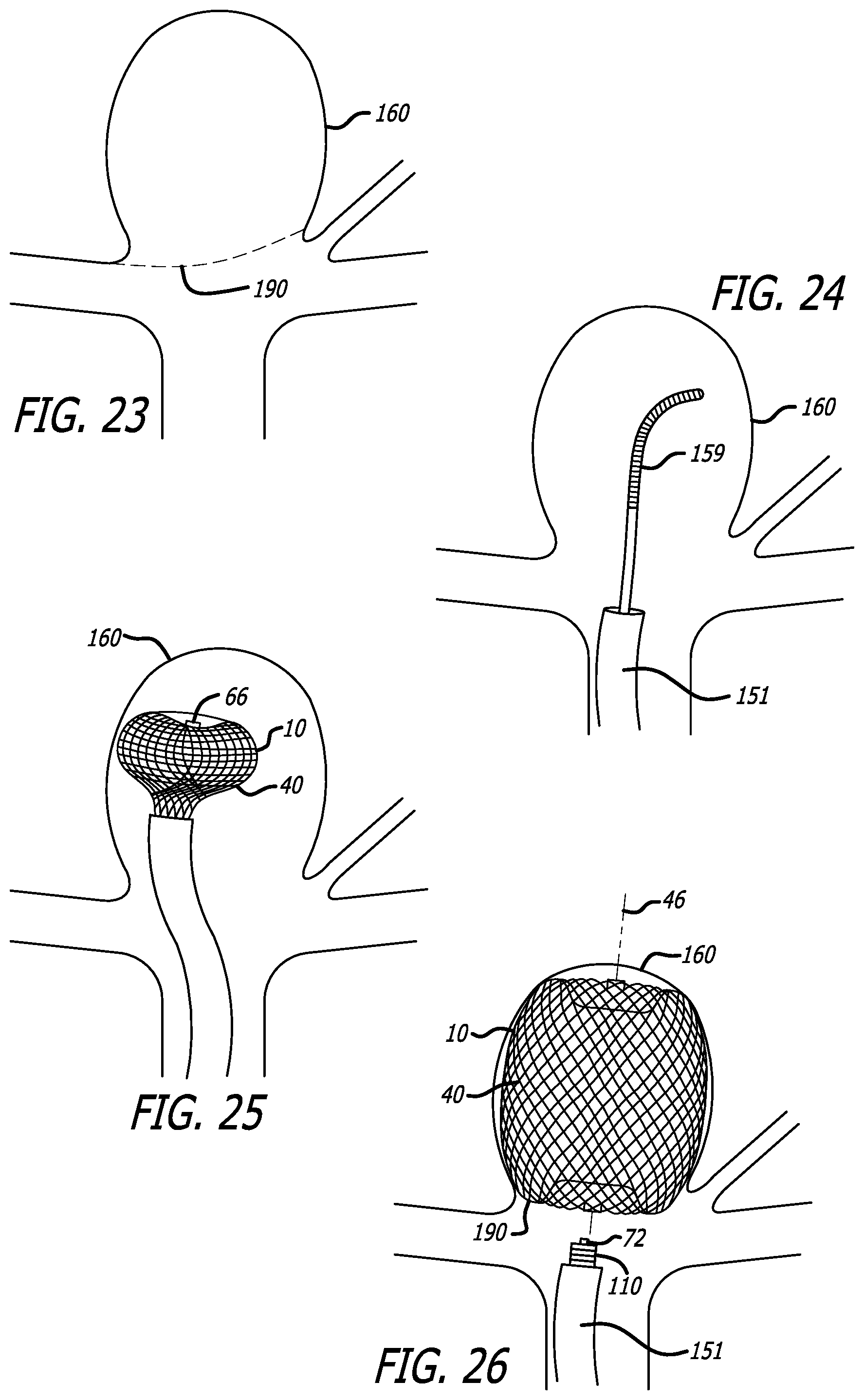 Patent US12318091 Figure 15 – Filamentary devices for treatment of vascular defects