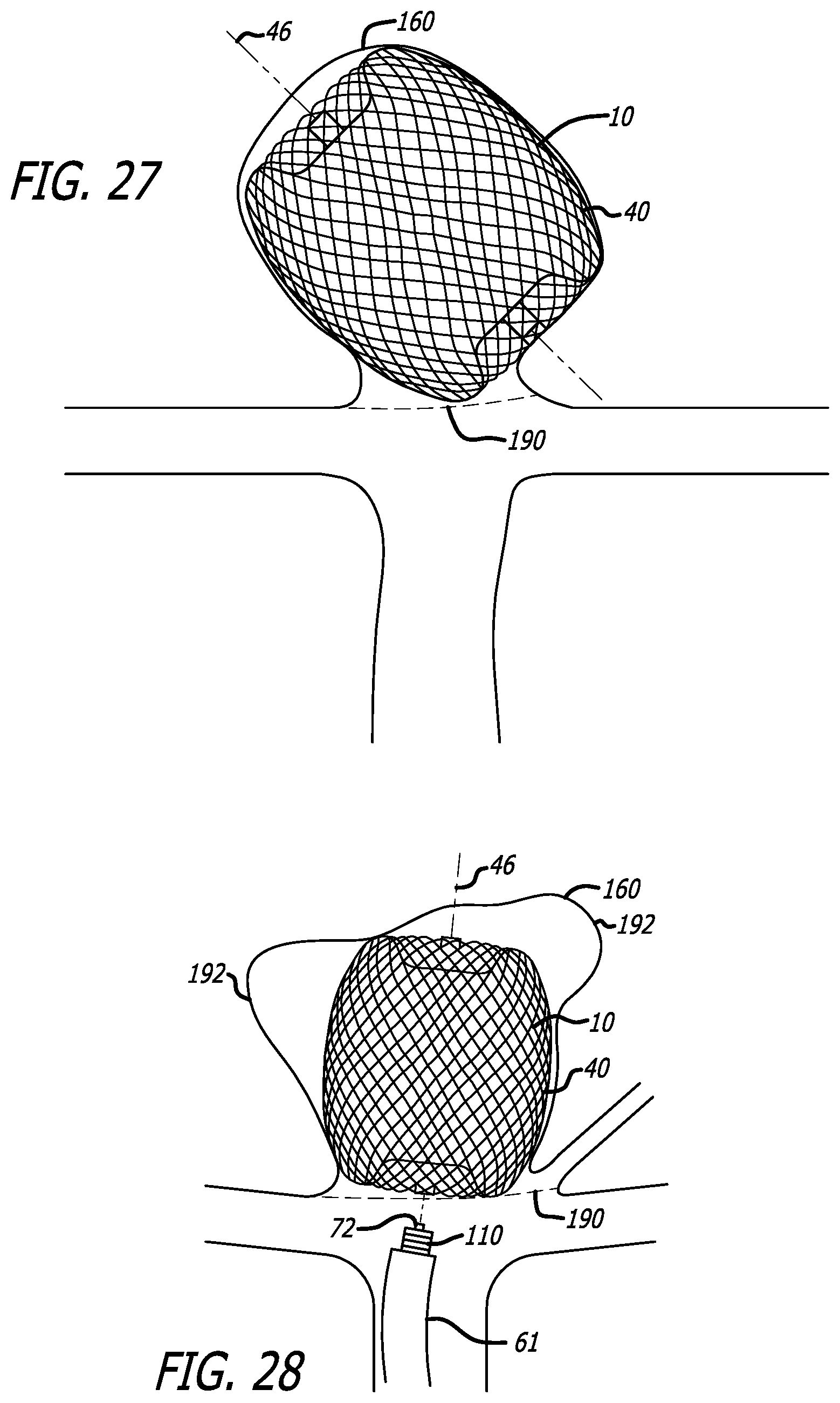 Patent US12318091 Figure 16 – Filamentary devices for treatment of vascular defects