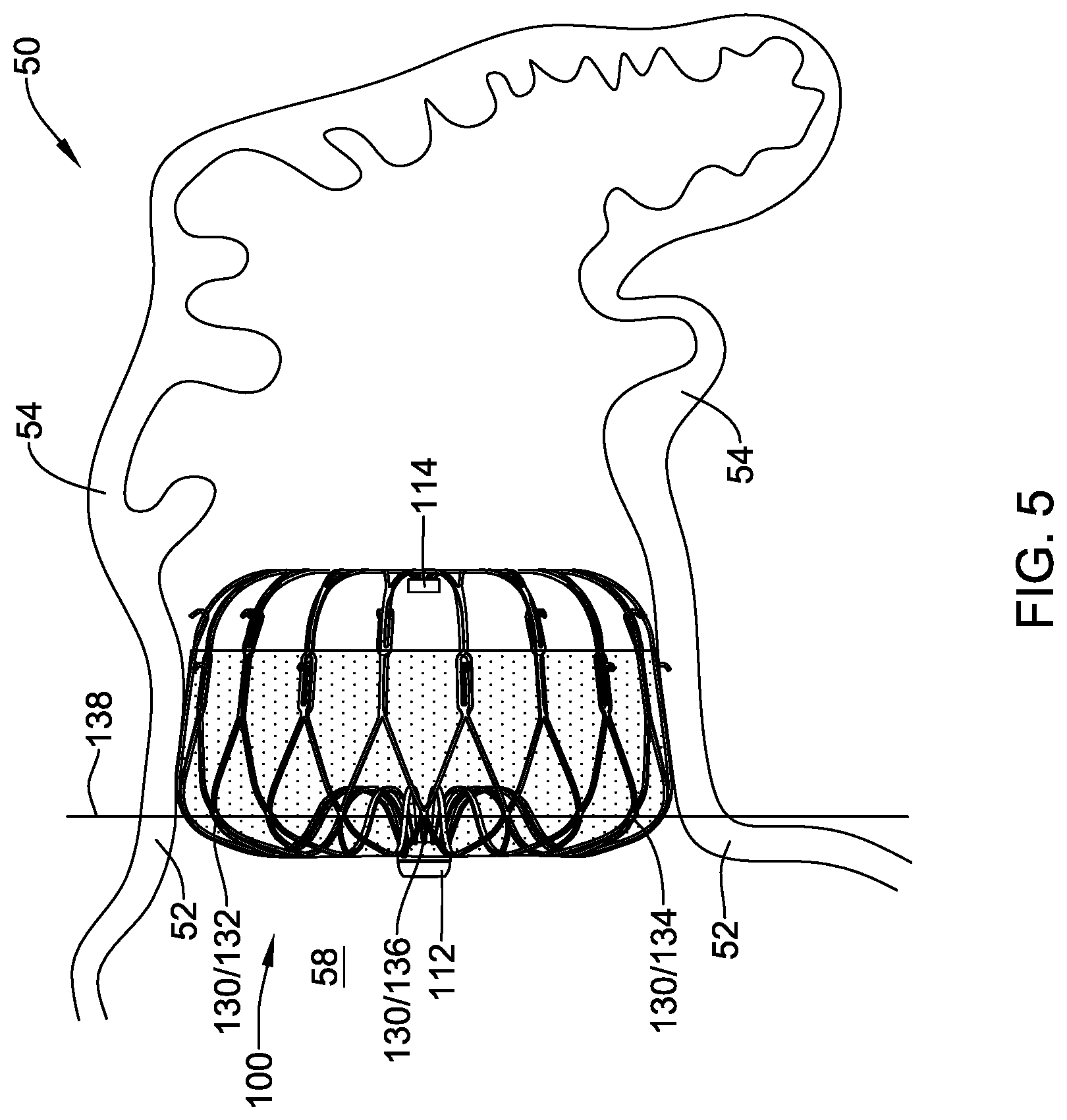 Patent US12318092 Figure 5 – Left atrial appendage implant