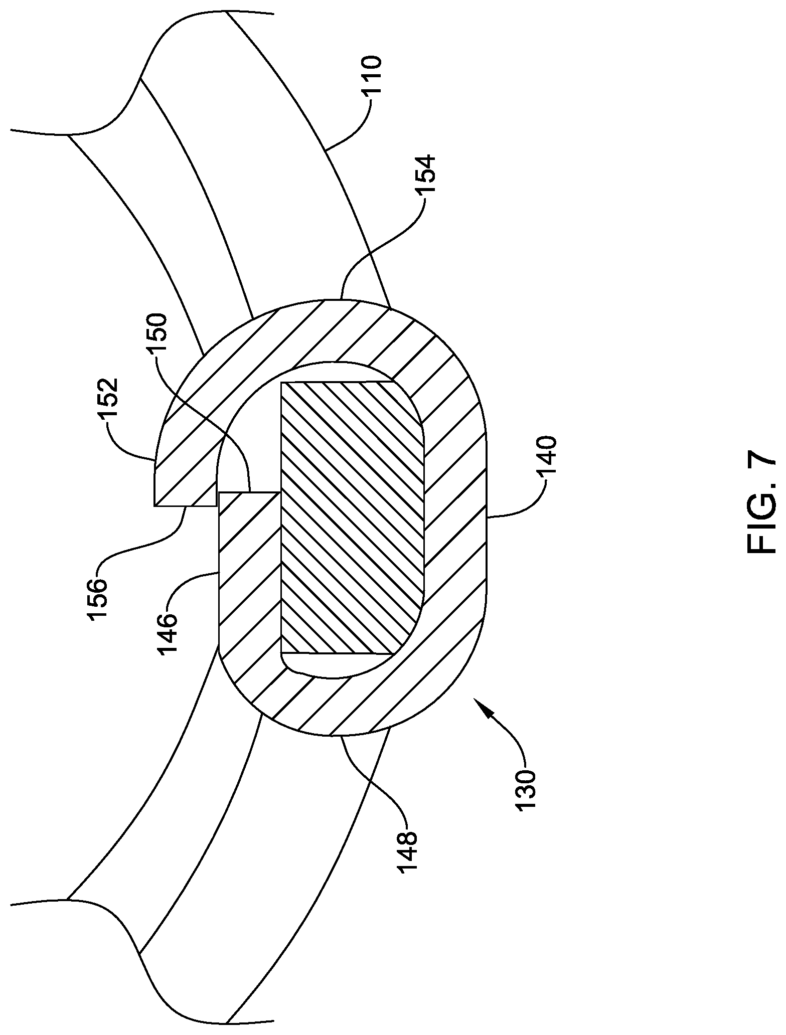 Patent US12318092 Figure 7 – Left atrial appendage implant