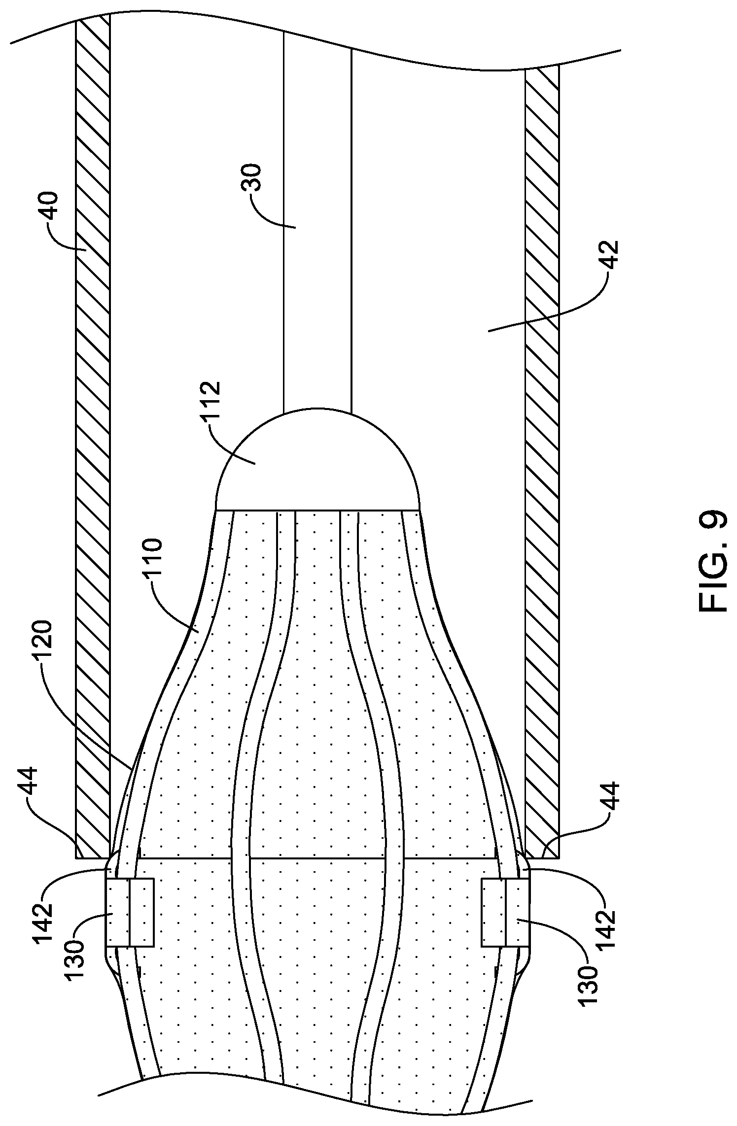 Patent US12318092 Figure 9 – Left atrial appendage implant