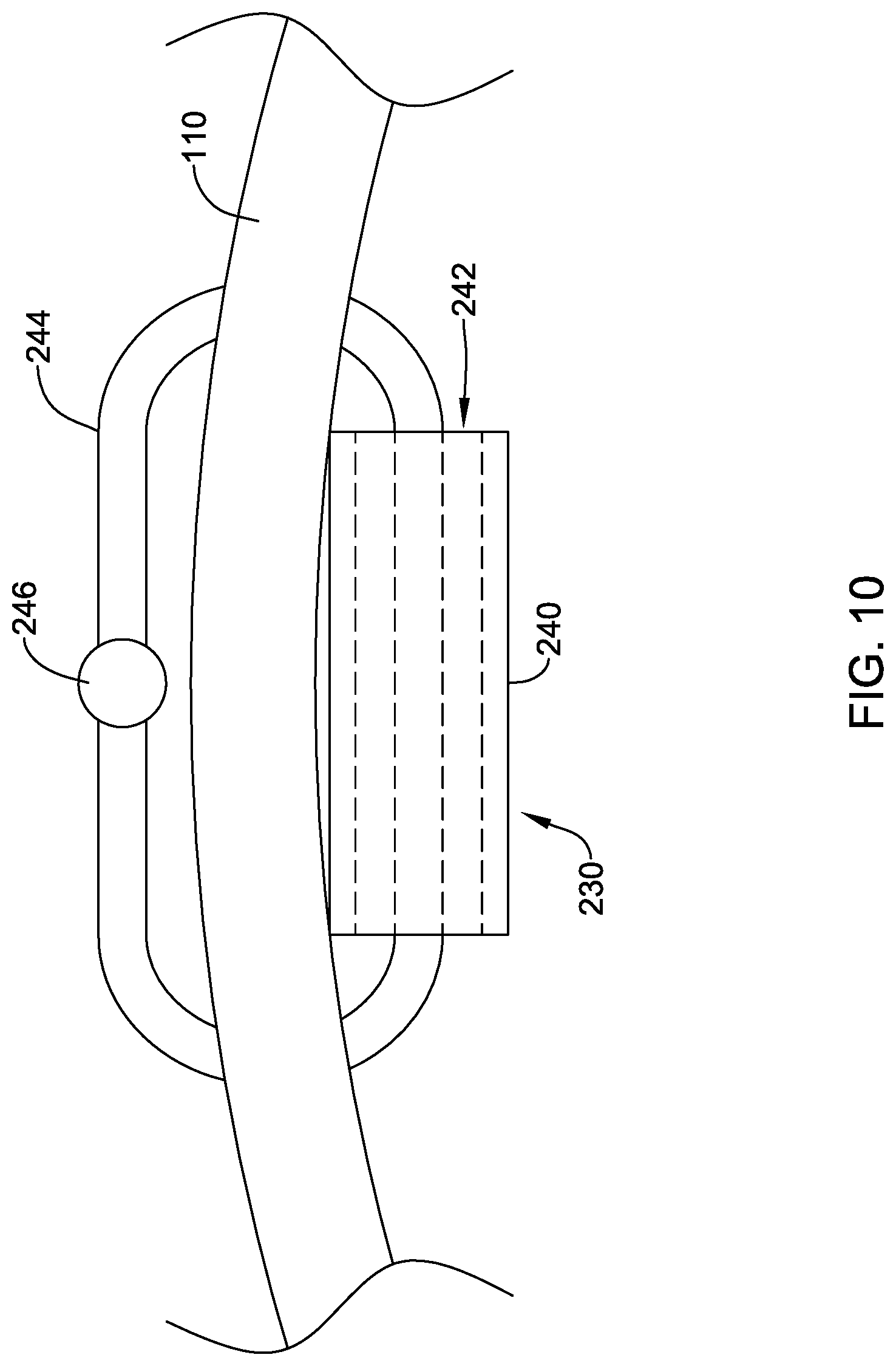 Patent US12318092 Figure 10 – Left atrial appendage implant