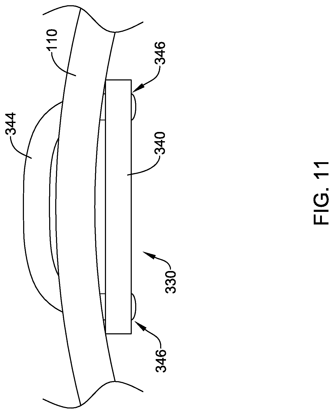 Patent US12318092 Figure 11 – Left atrial appendage implant