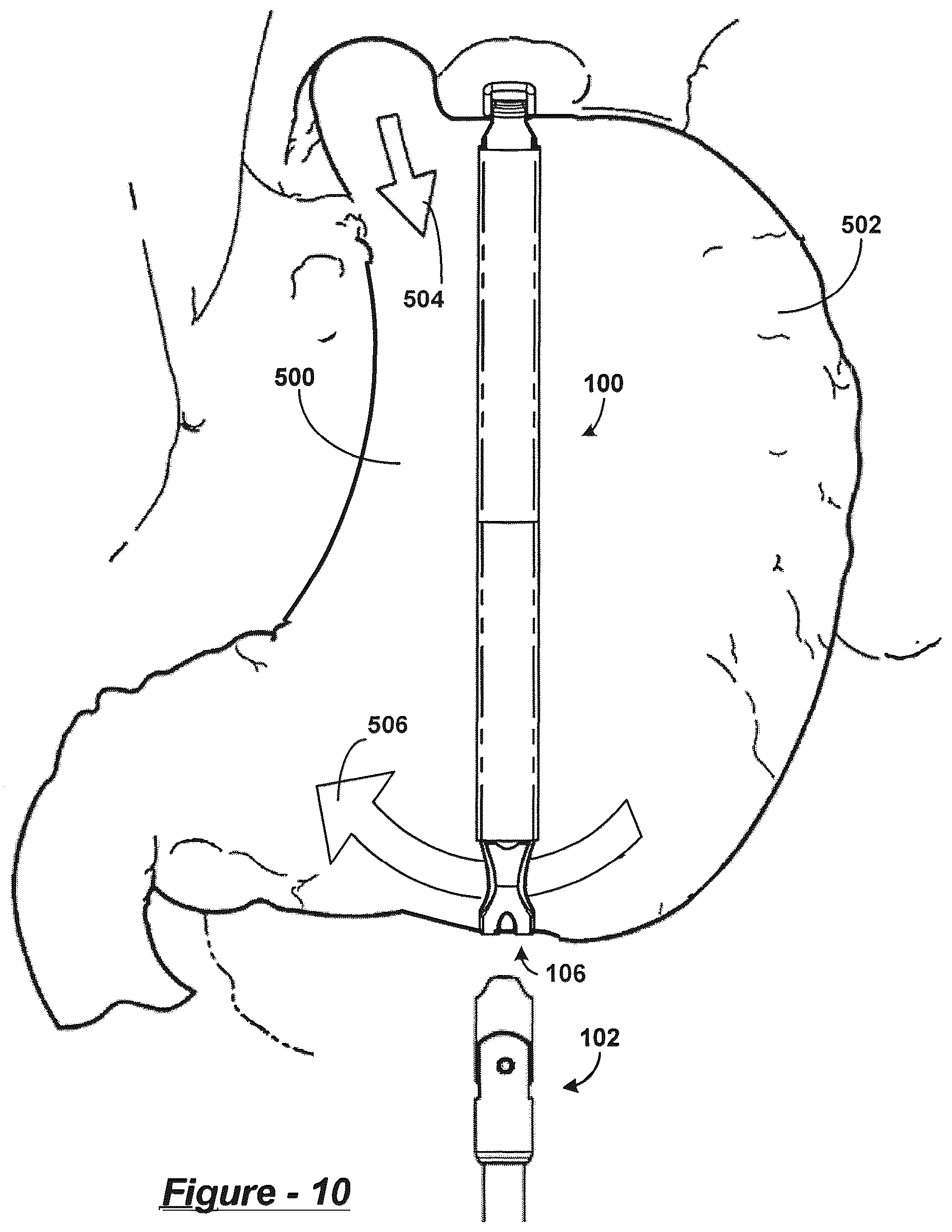 Patent US12318093 Figure 19 – Polymer overmolded bariatric clamp and method of installing