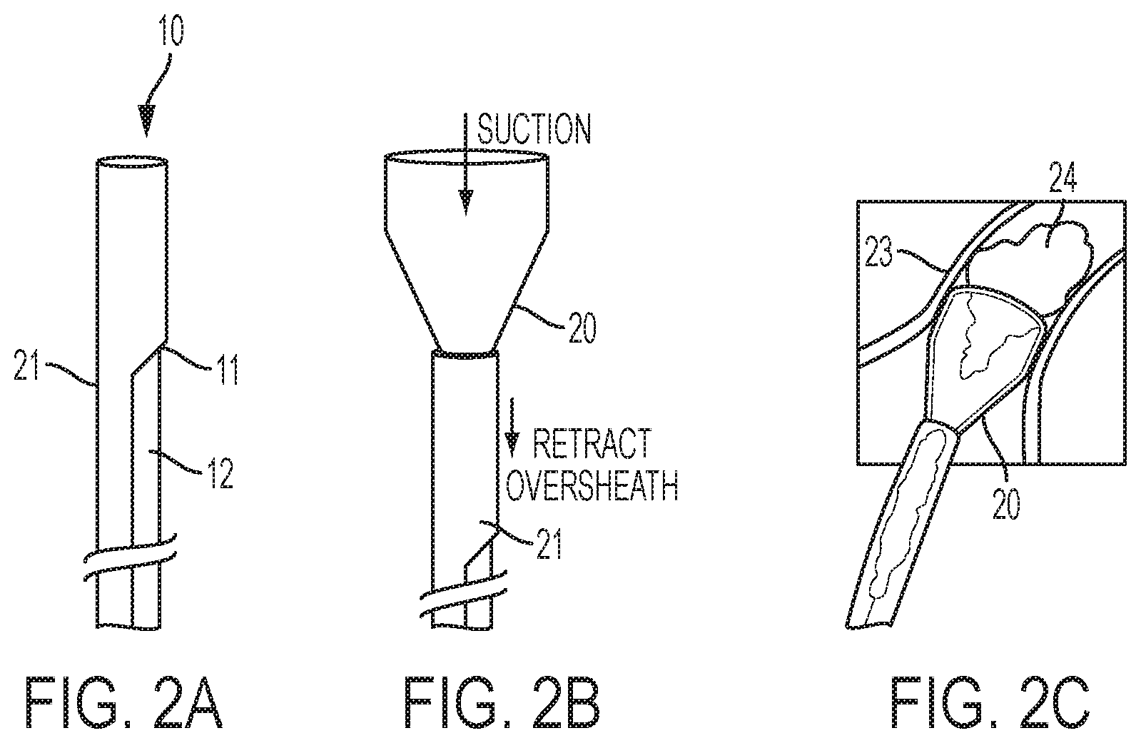 Patent US12318097 Figure 2 – Systems and methods for removing undesirable material within a circulatory system