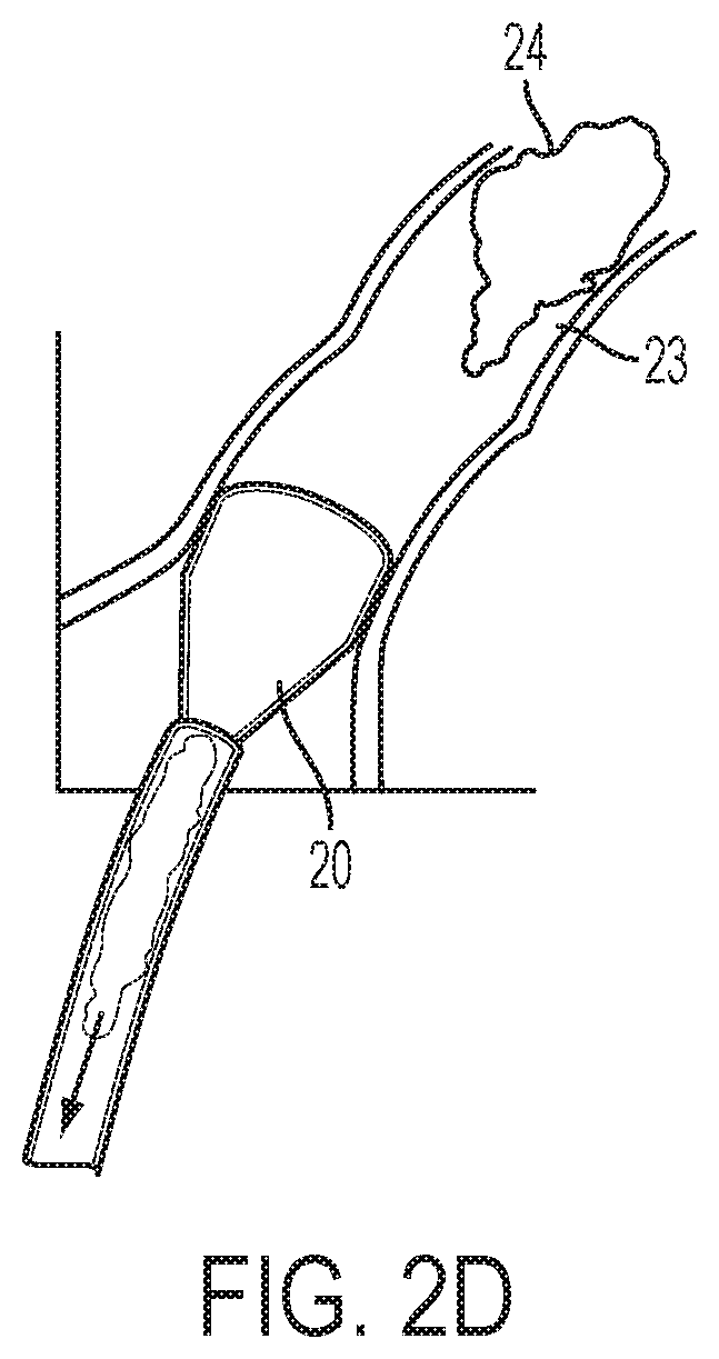 Patent US12318097 Figure 3 – Systems and methods for removing undesirable material within a circulatory system