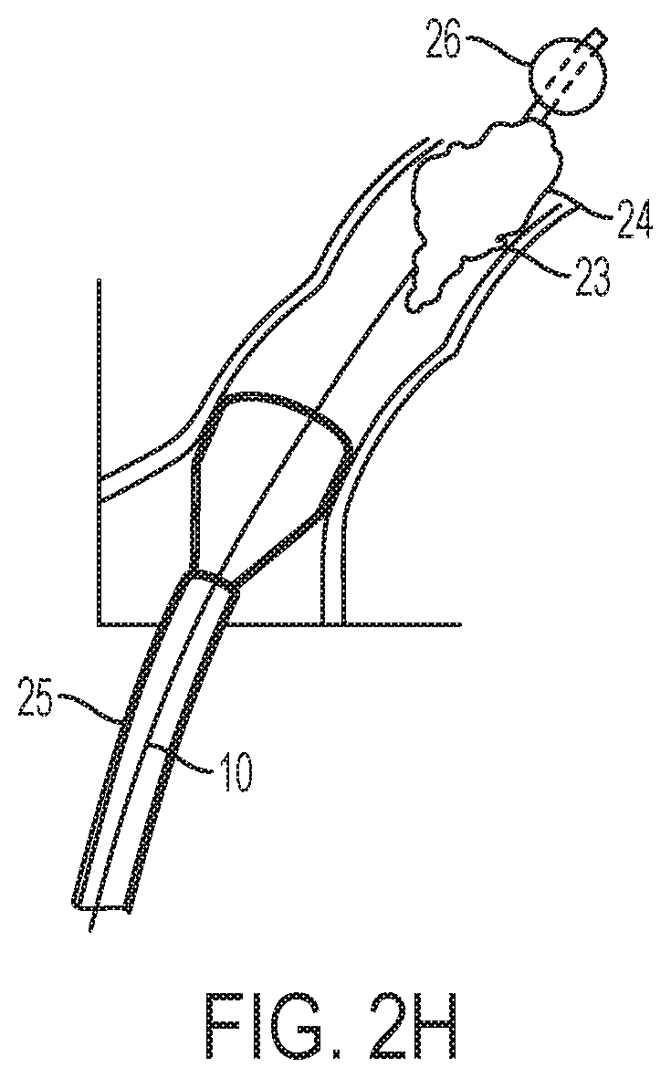 Patent US12318097 Figure 5 – Systems and methods for removing undesirable material within a circulatory system