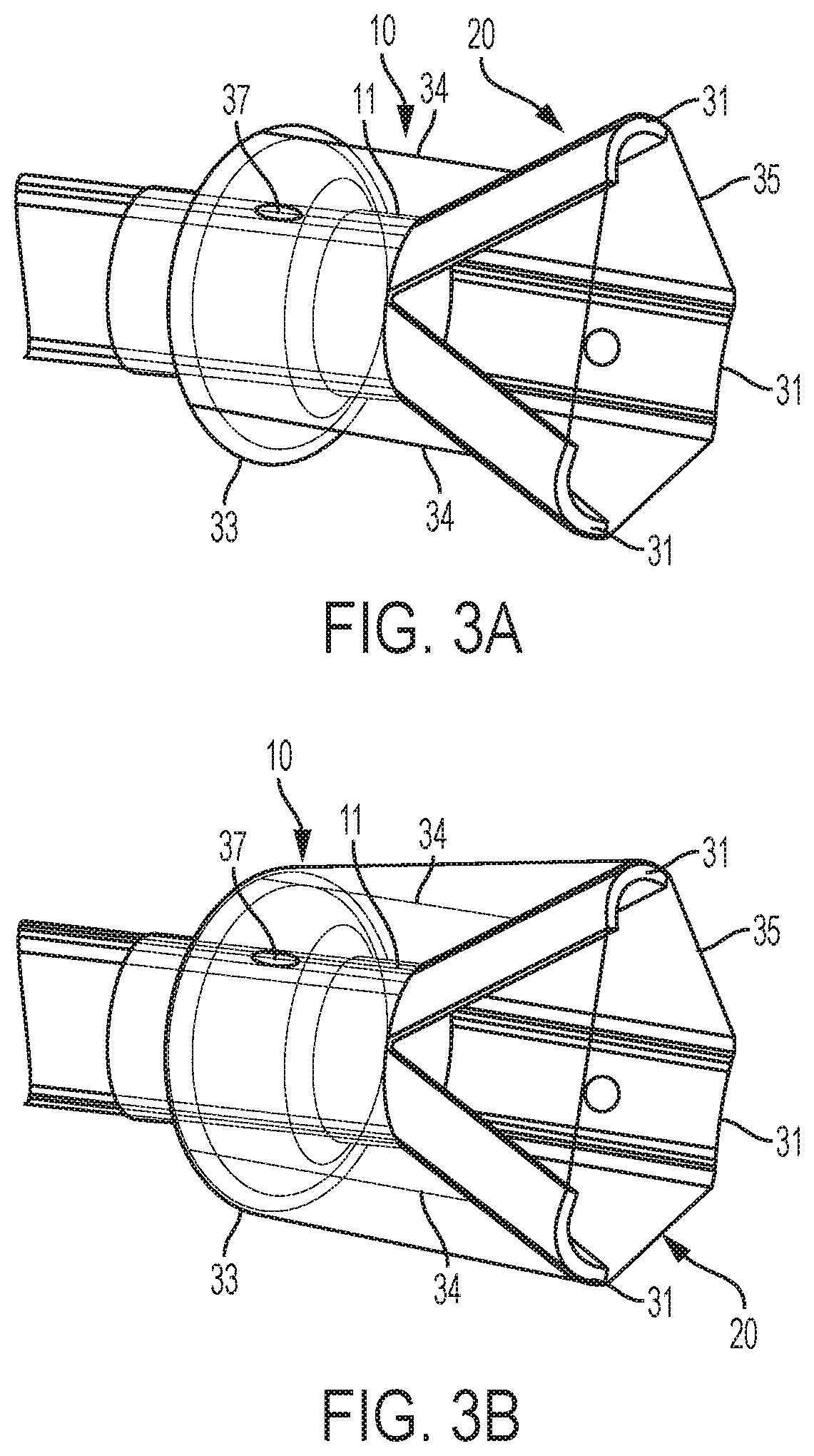 Patent US12318097 Figure 6 – Systems and methods for removing undesirable material within a circulatory system