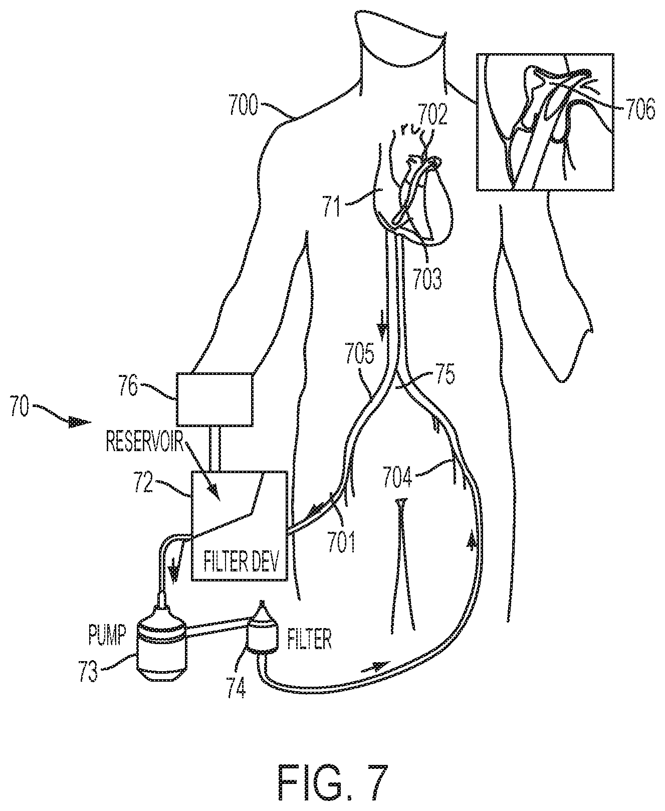 Patent US12318097 Figure 11 – Systems and methods for removing undesirable material within a circulatory system