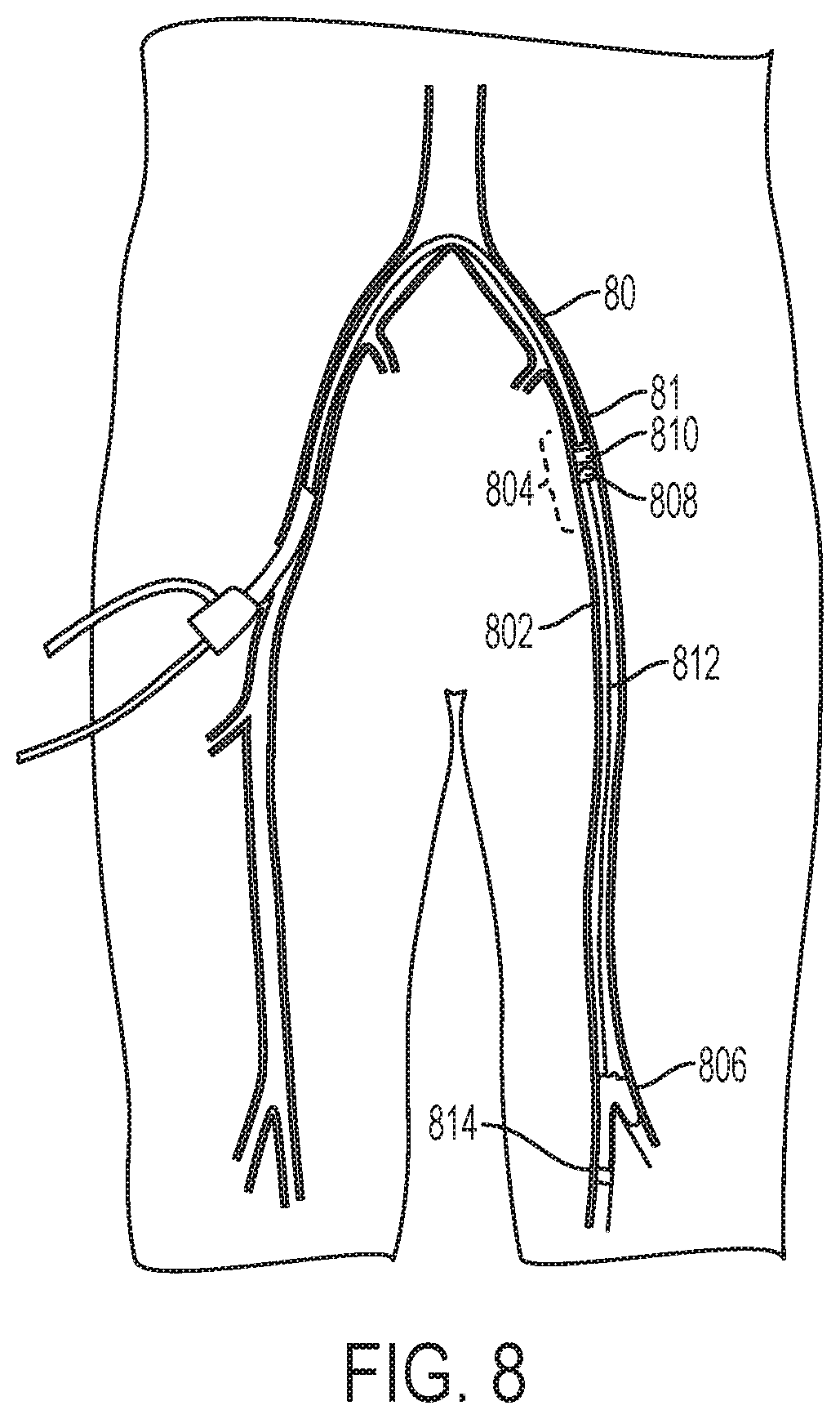 Patent US12318097 Figure 12 – Systems and methods for removing undesirable material within a circulatory system
