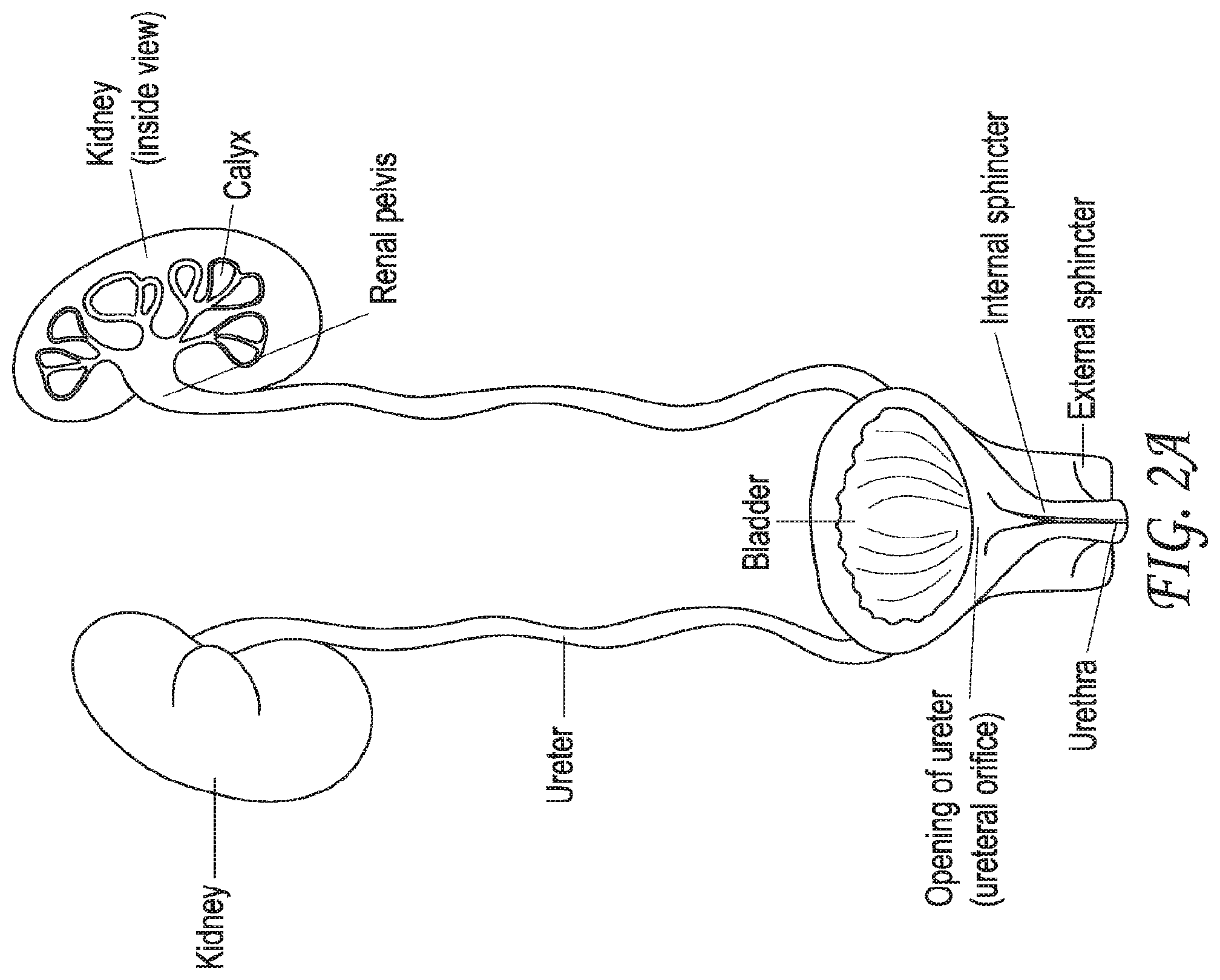 Patent US12318099 Figure 2 – Devices and methods for minimally invasive kidney stone removal by combined aspiration and irrigation