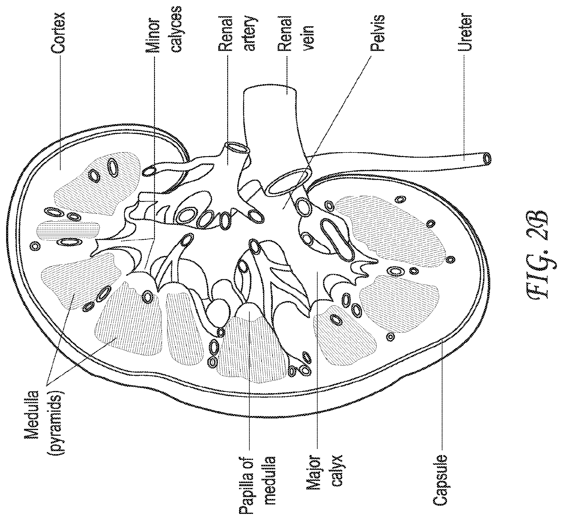 Patent US12318099 Figure 3 – Devices and methods for minimally invasive kidney stone removal by combined aspiration and irrigation