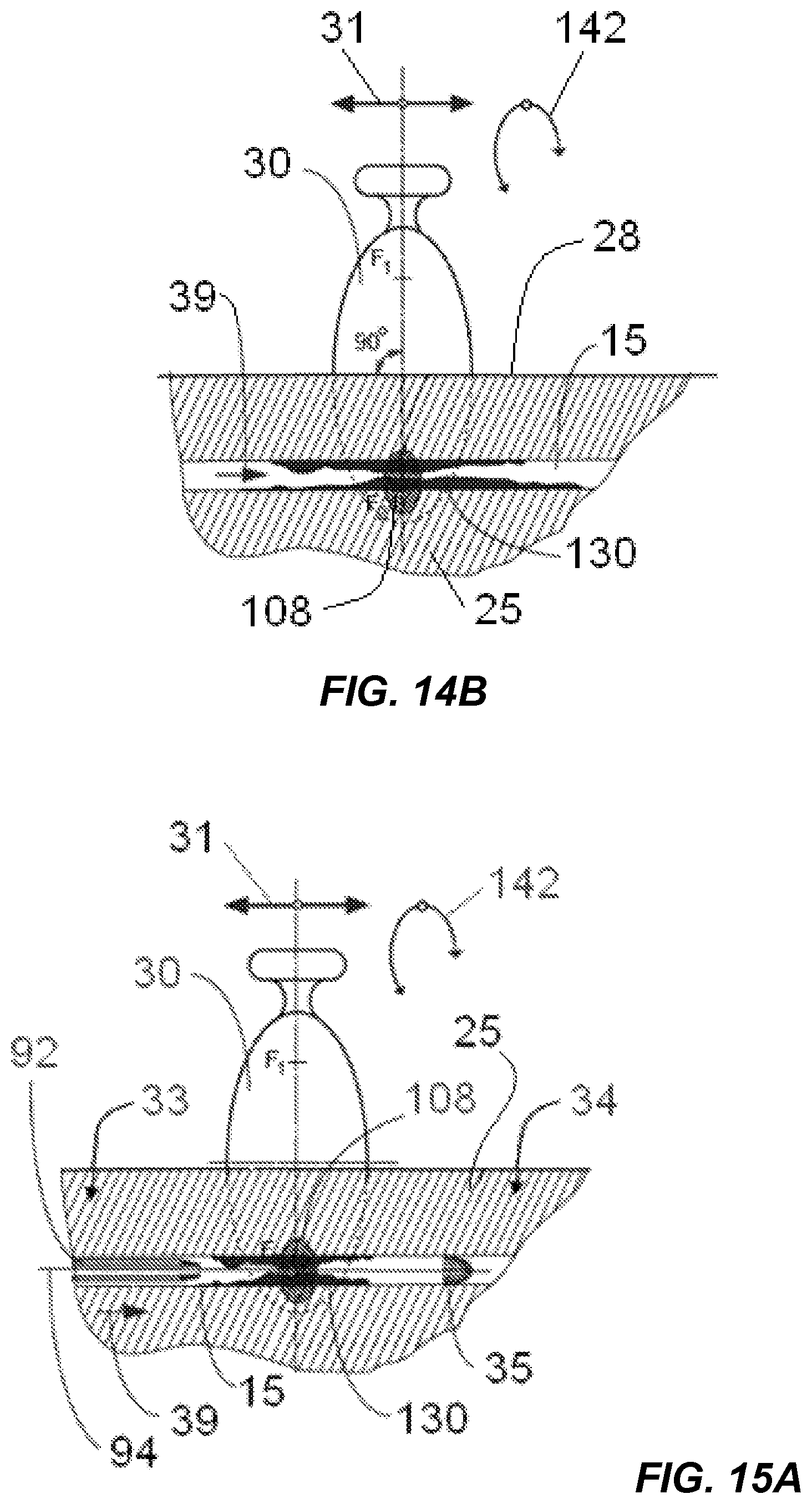 Patent US12318100 Figure 9 – Shock wave vessel catheter system and method