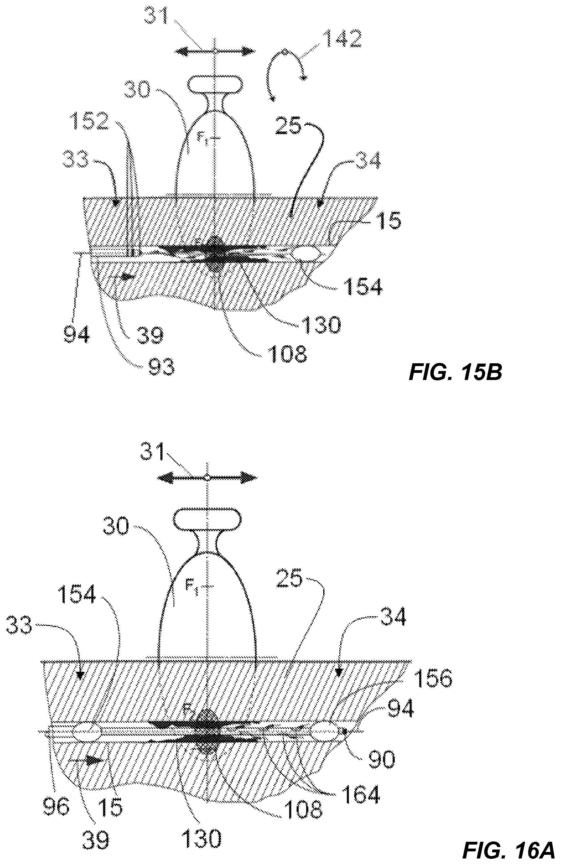 Patent US12318100 Figure 10 – Shock wave vessel catheter system and method