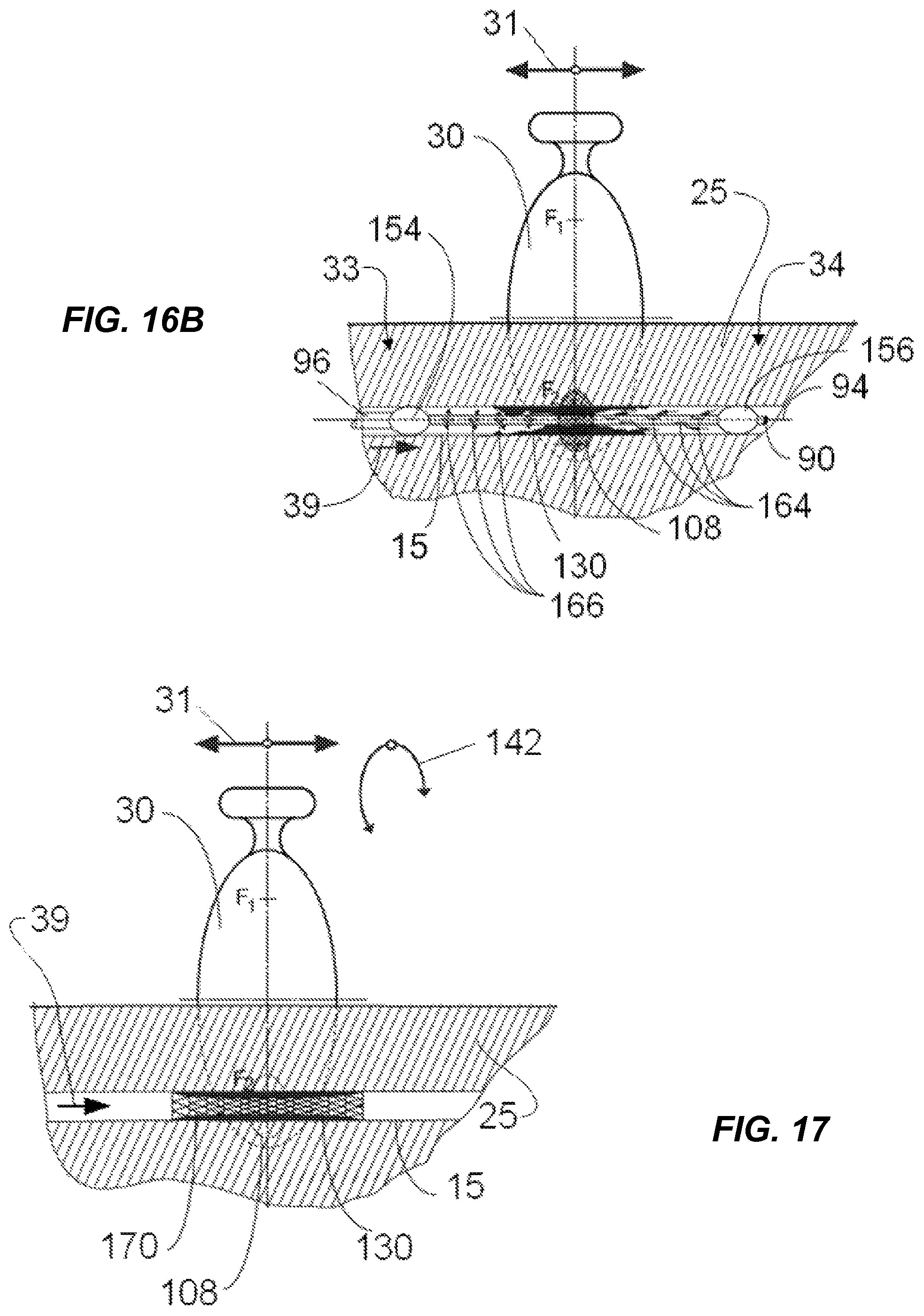 Patent US12318100 Figure 11 – Shock wave vessel catheter system and method