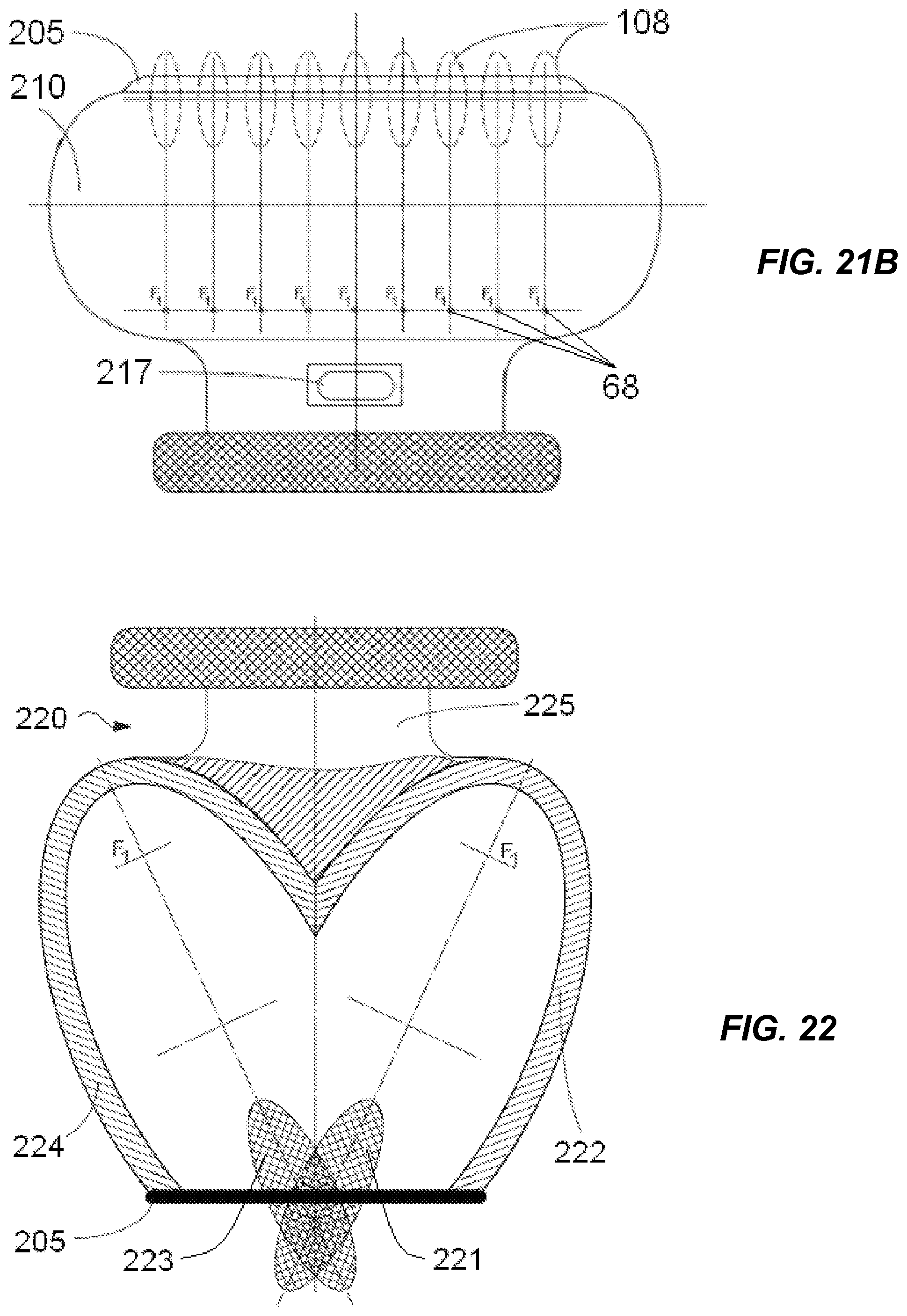 Patent US12318100 Figure 14 – Shock wave vessel catheter system and method