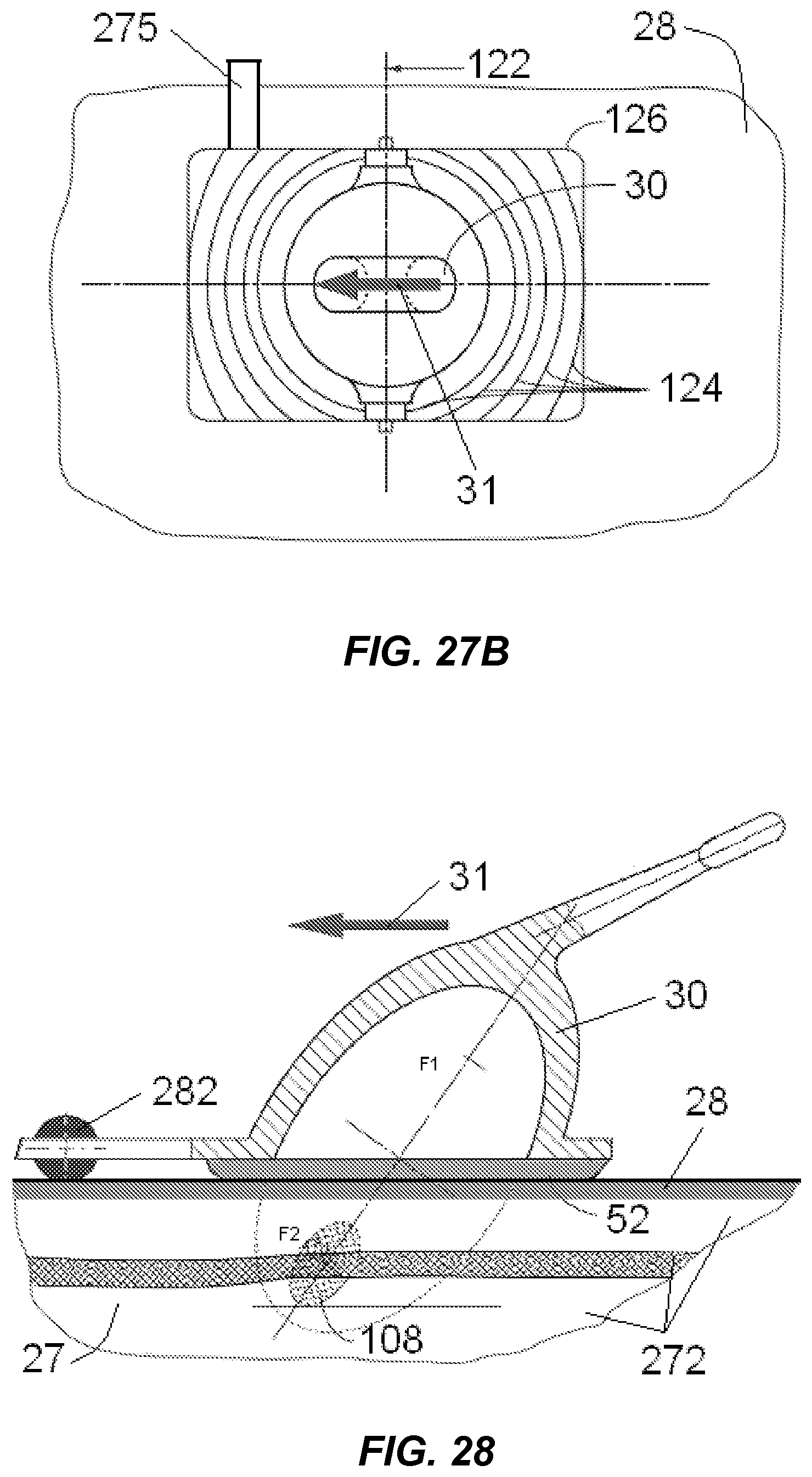 Patent US12318100 Figure 18 – Shock wave vessel catheter system and method