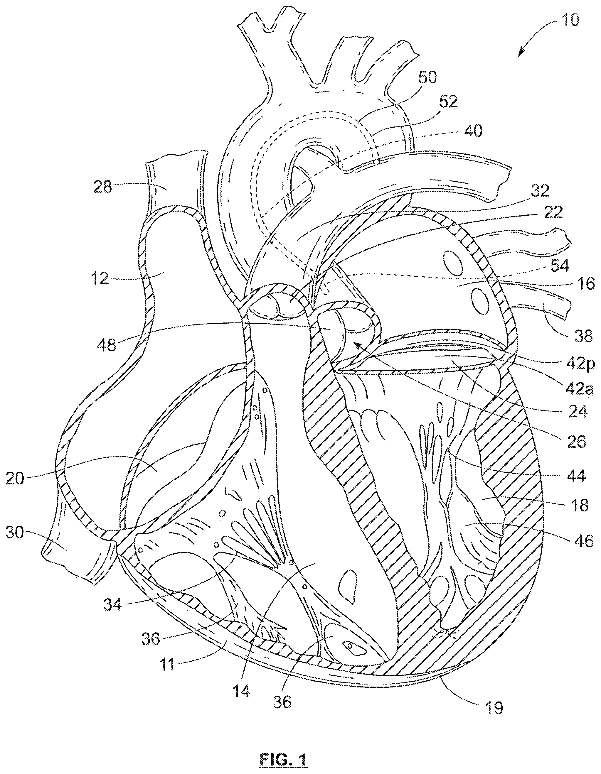 Patent US12318105 Figure 1 – Biscuspid valve dissection device