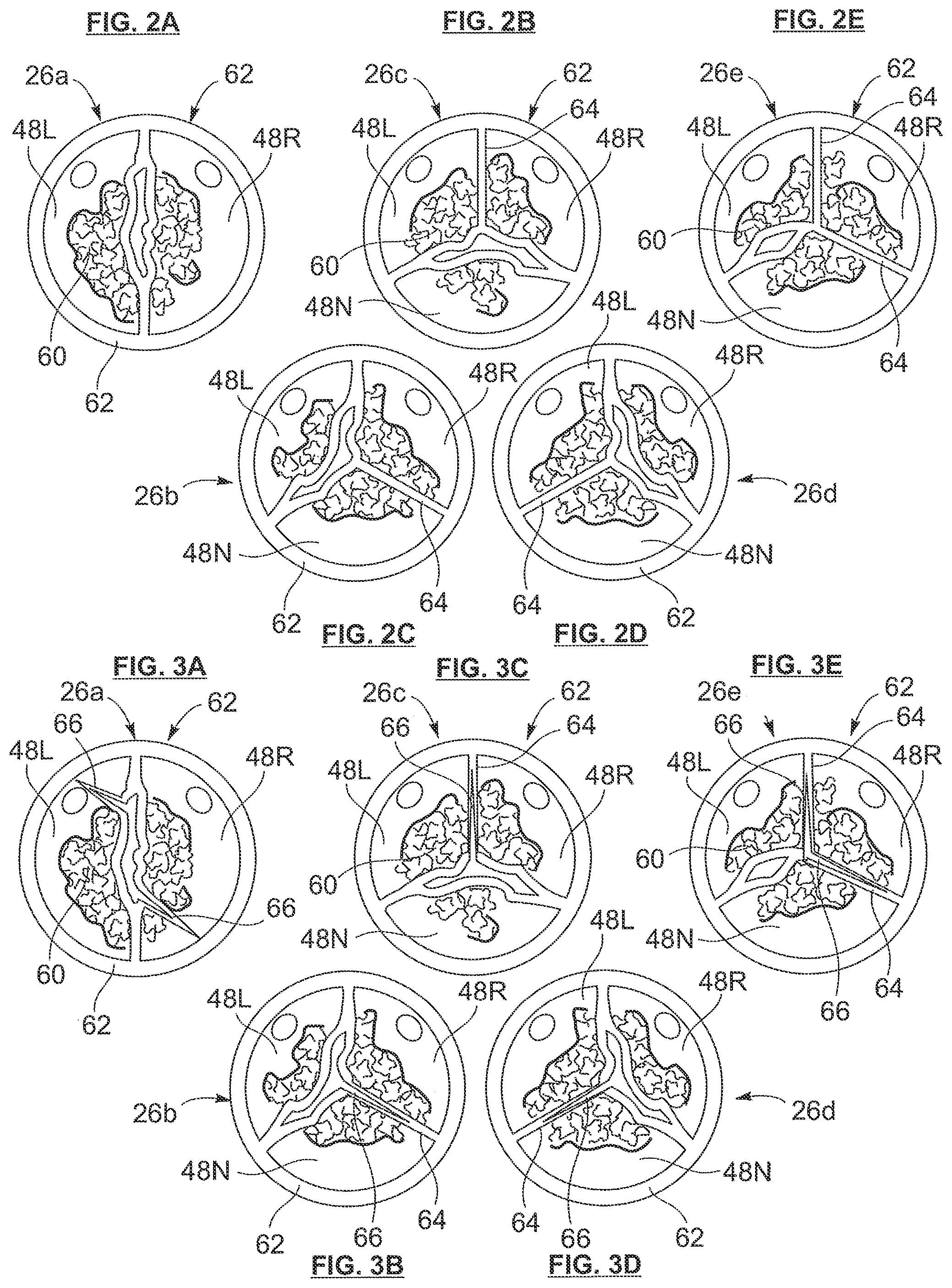 Patent US12318105 Figure 2 – Biscuspid valve dissection device