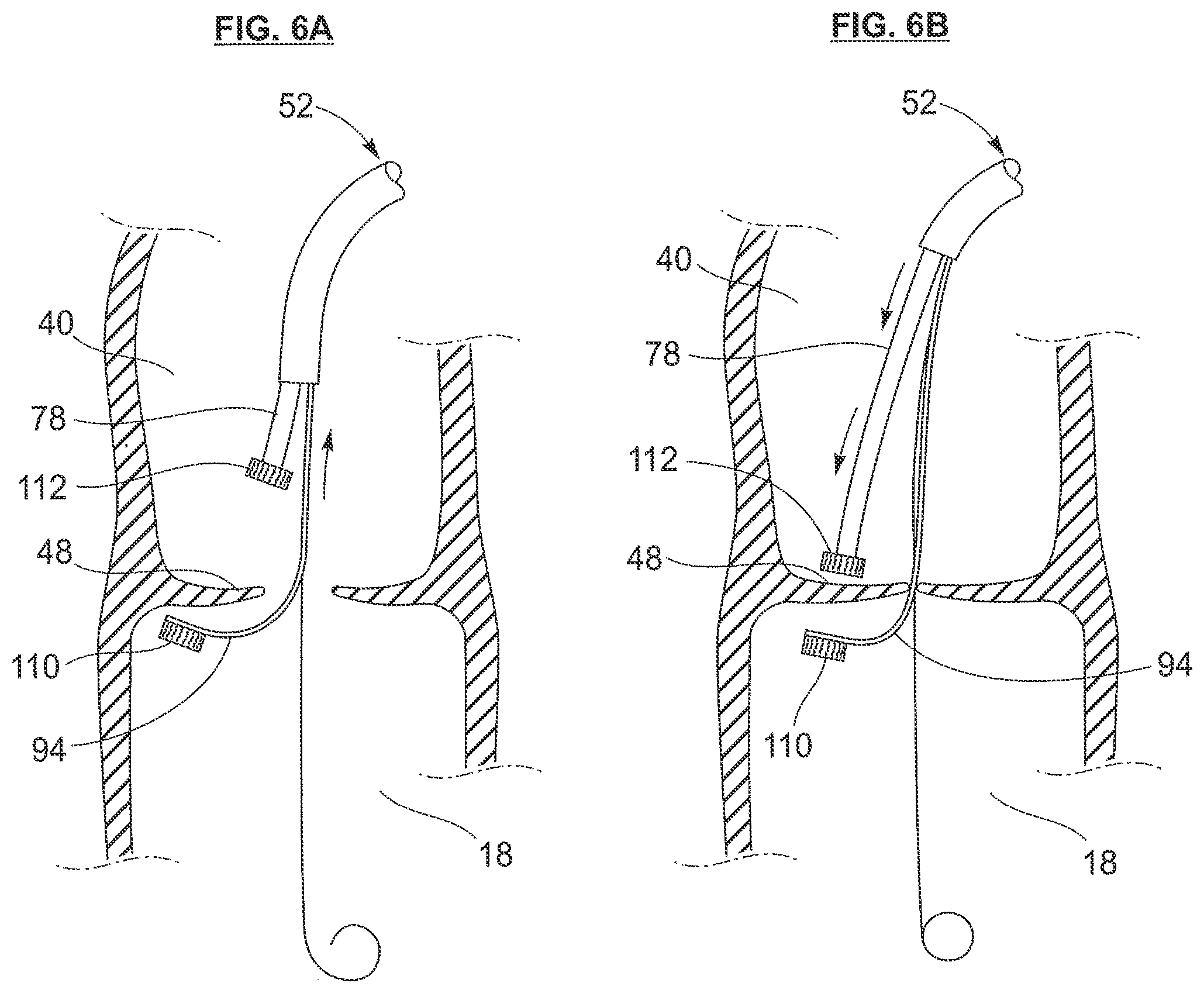 Patent US12318105 Figure 5 – Biscuspid valve dissection device
