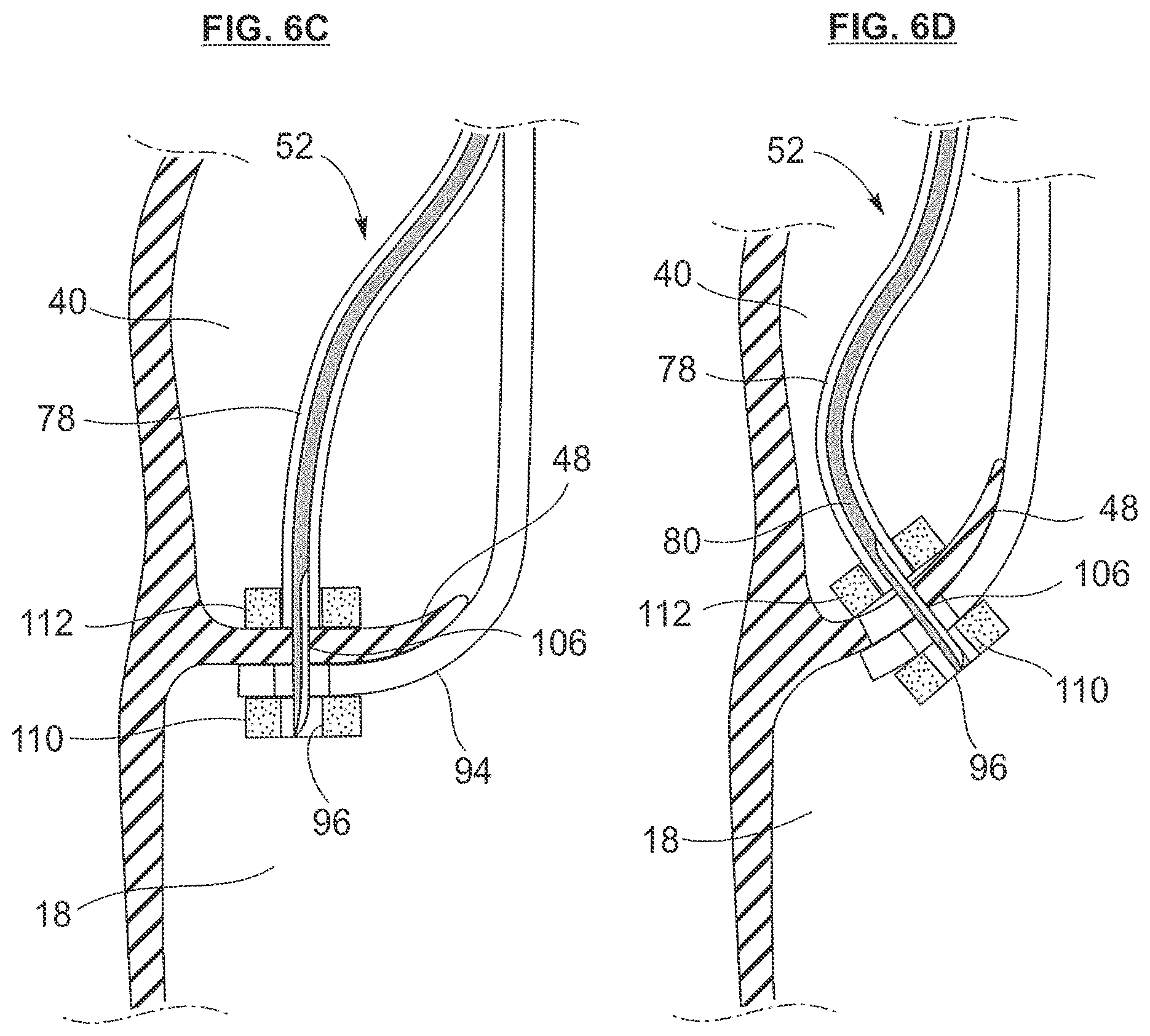 Patent US12318105 Figure 6 – Biscuspid valve dissection device