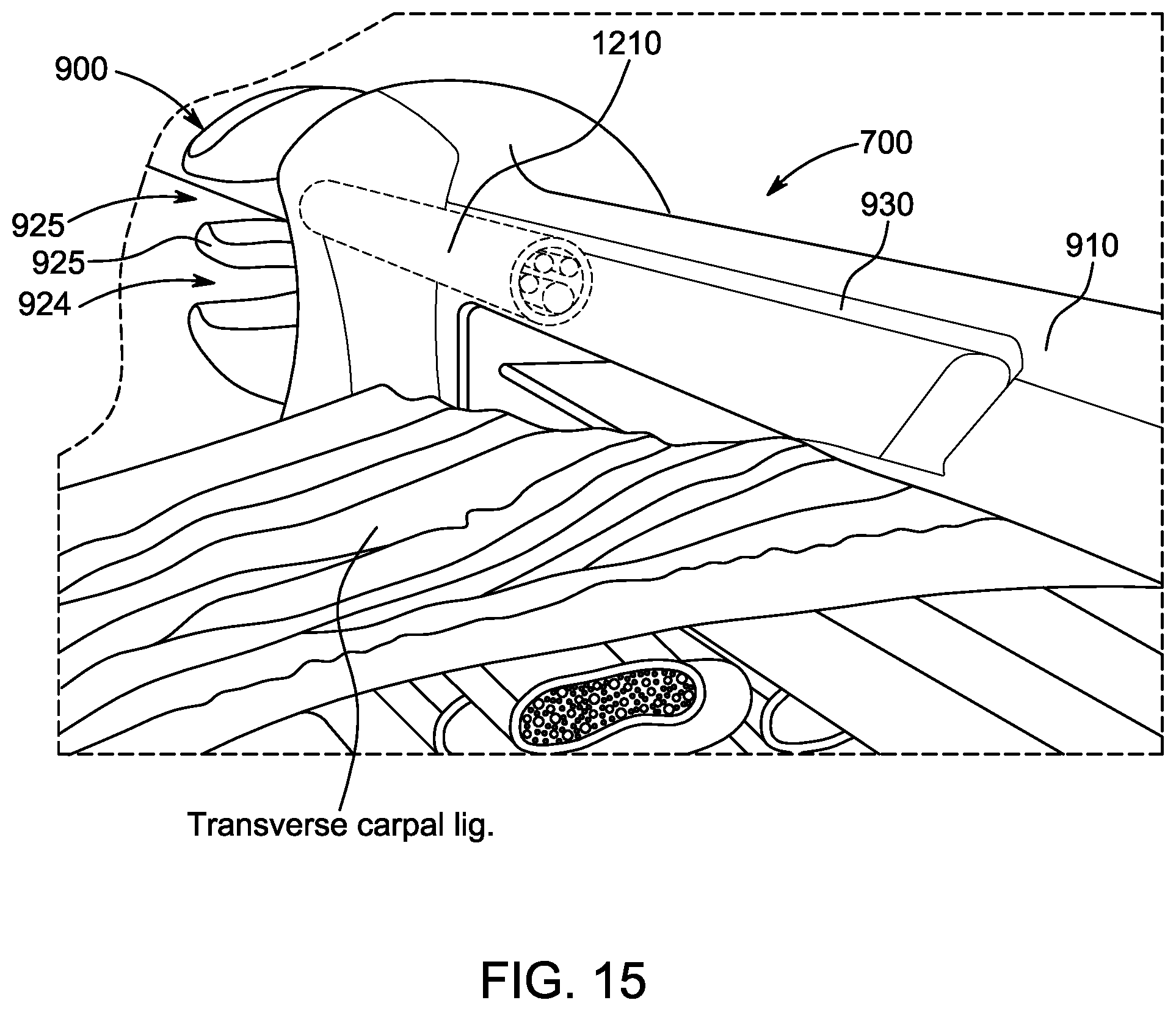 Patent US12318106 Figure 15 – Method for using a surgical device to transect a transverse carpal ligament