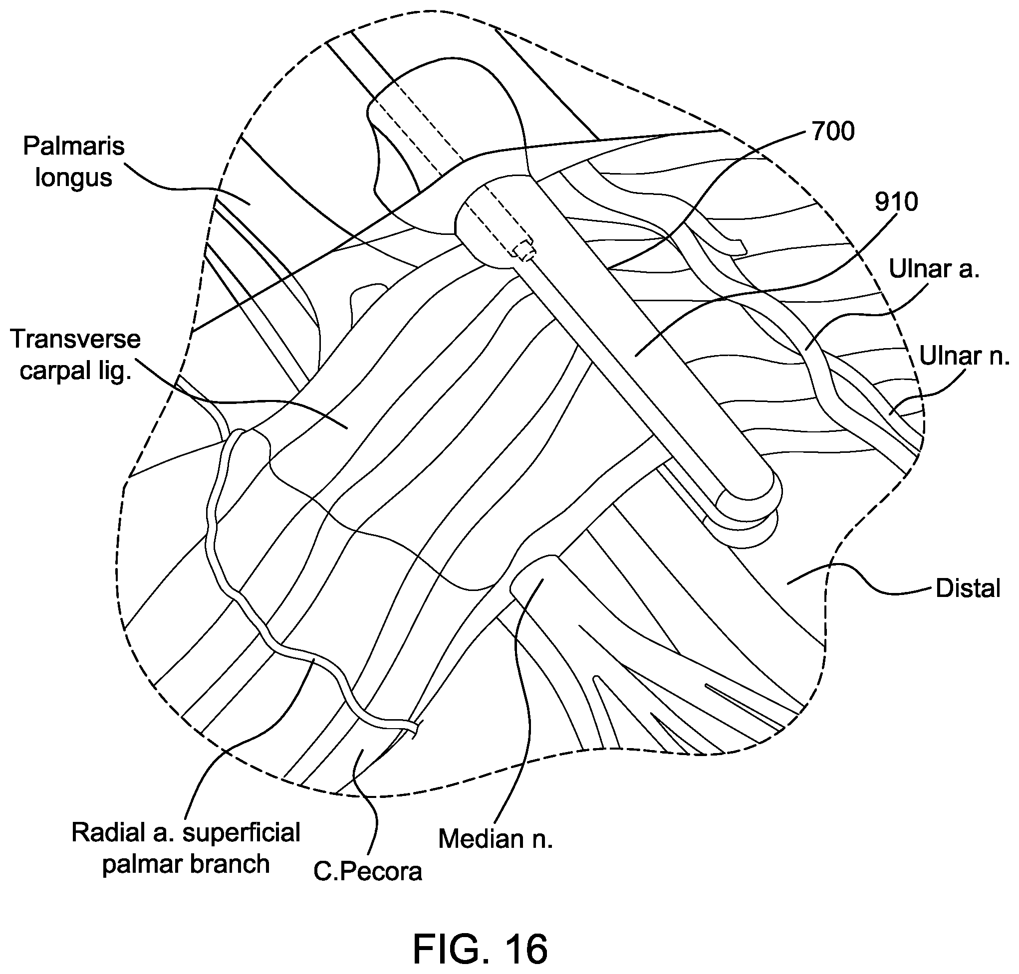 Patent US12318106 Figure 16 – Method for using a surgical device to transect a transverse carpal ligament