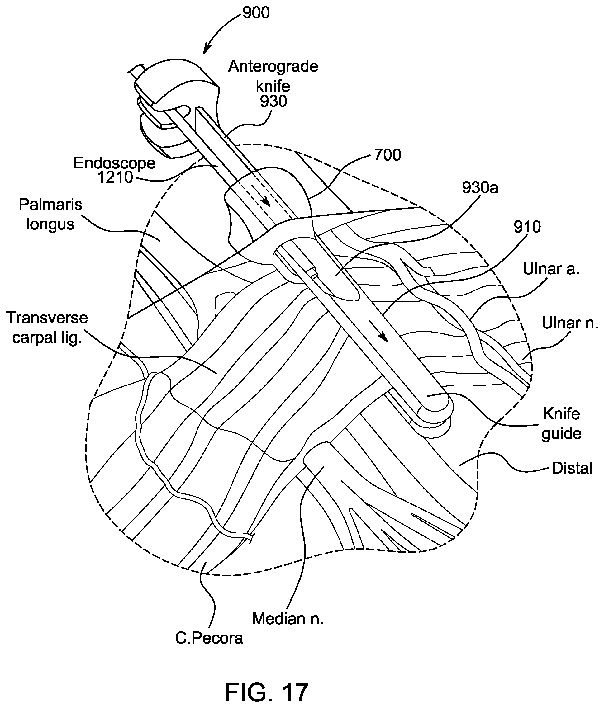 Patent US12318106 Figure 17 – Method for using a surgical device to transect a transverse carpal ligament