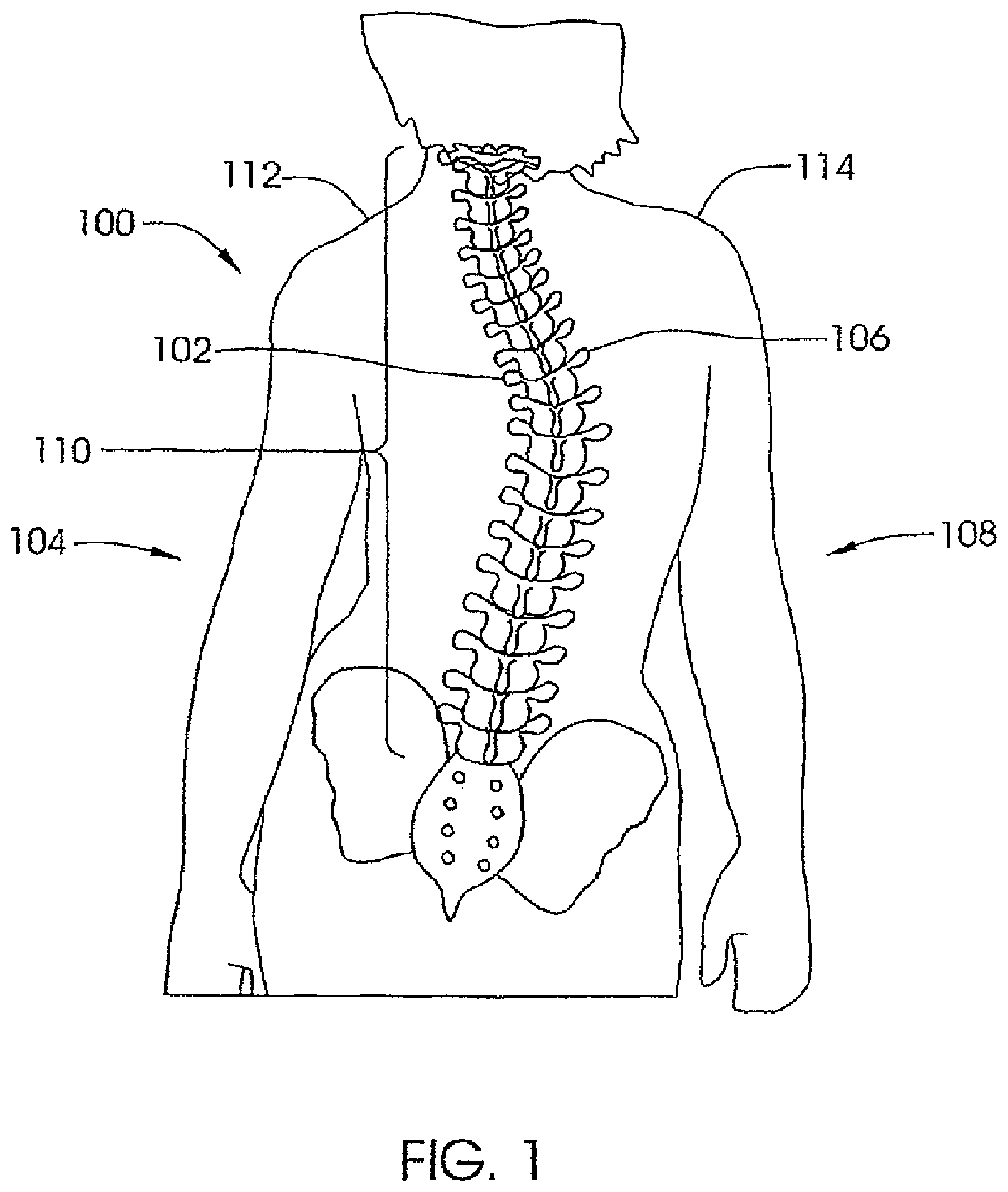 Patent US12318119 Figure 1 – Adjustable implant system