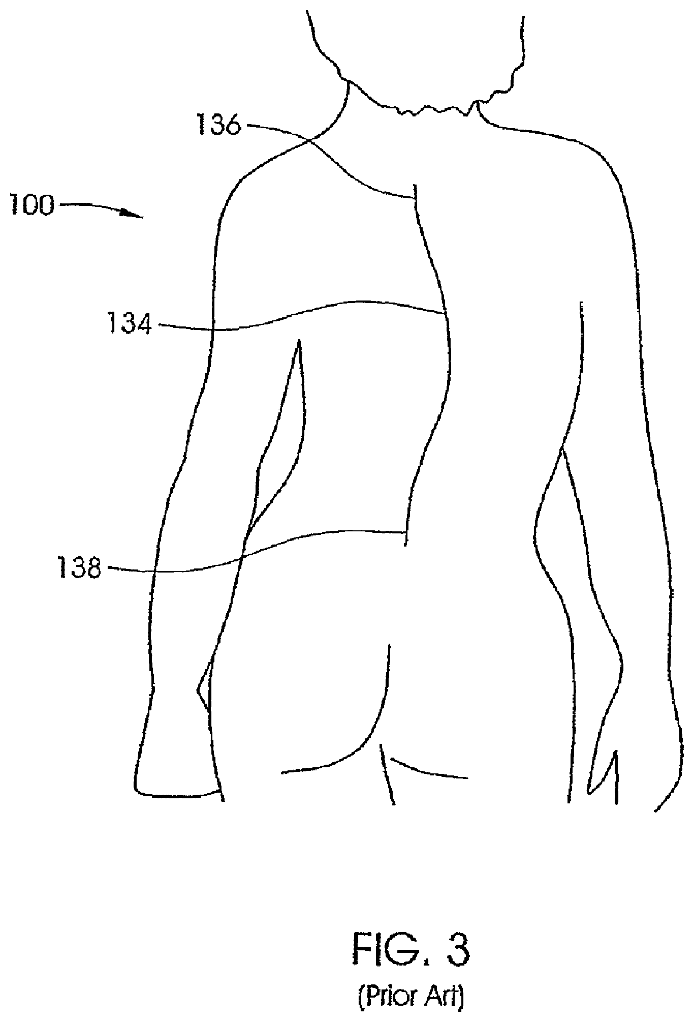 Patent US12318119 Figure 3 – Adjustable implant system