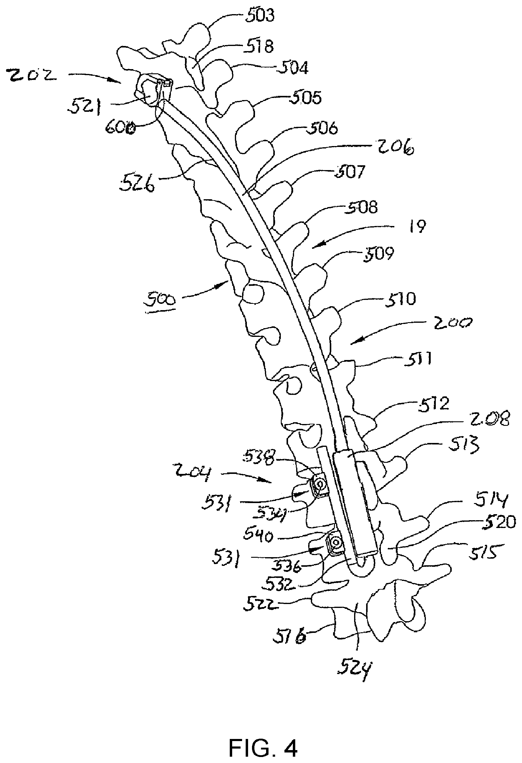 Patent US12318119 Figure 4 – Adjustable implant system