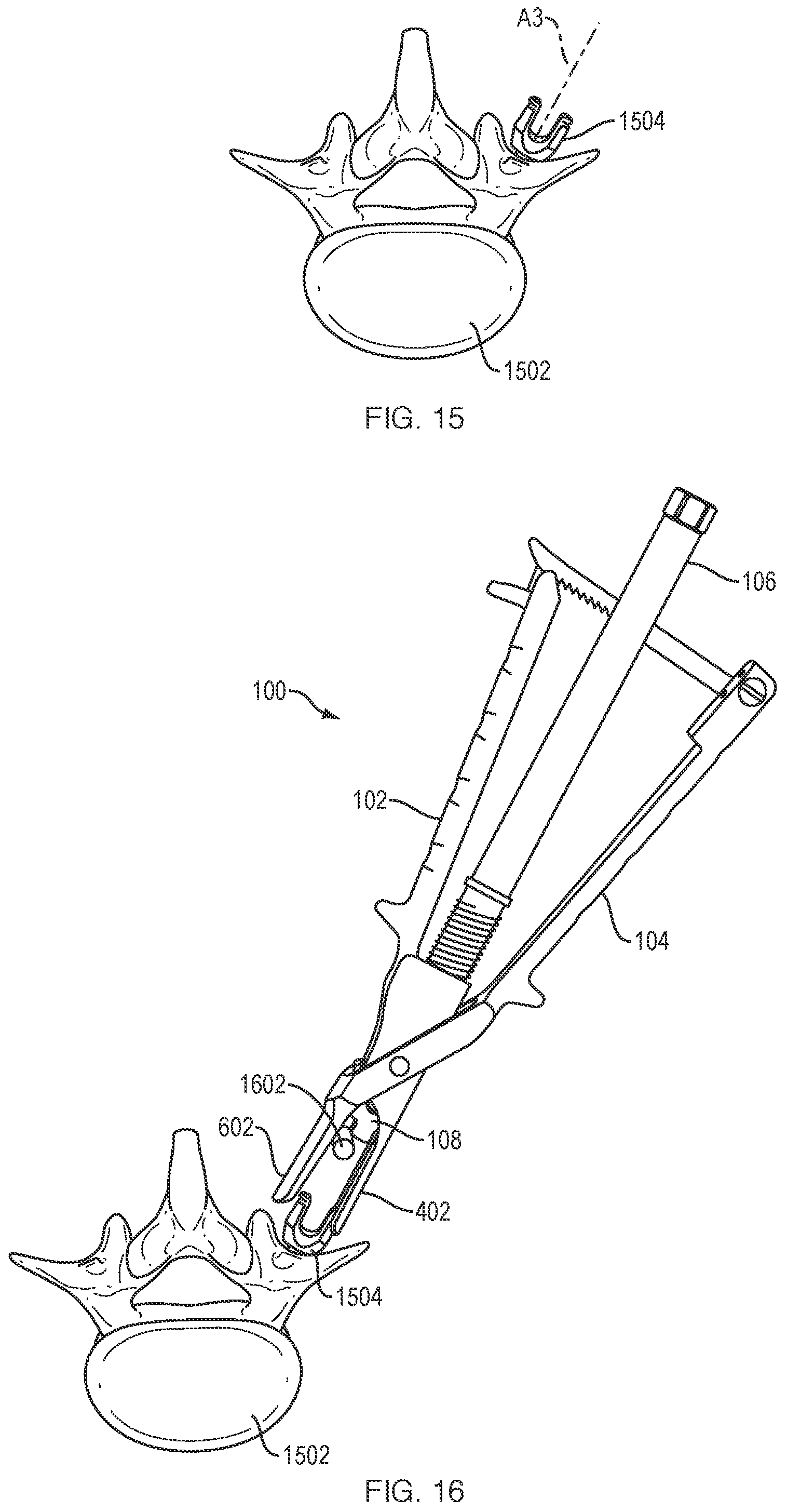 Patent US12318121 Figure 13 – Biplanar forceps reducers and methods of use