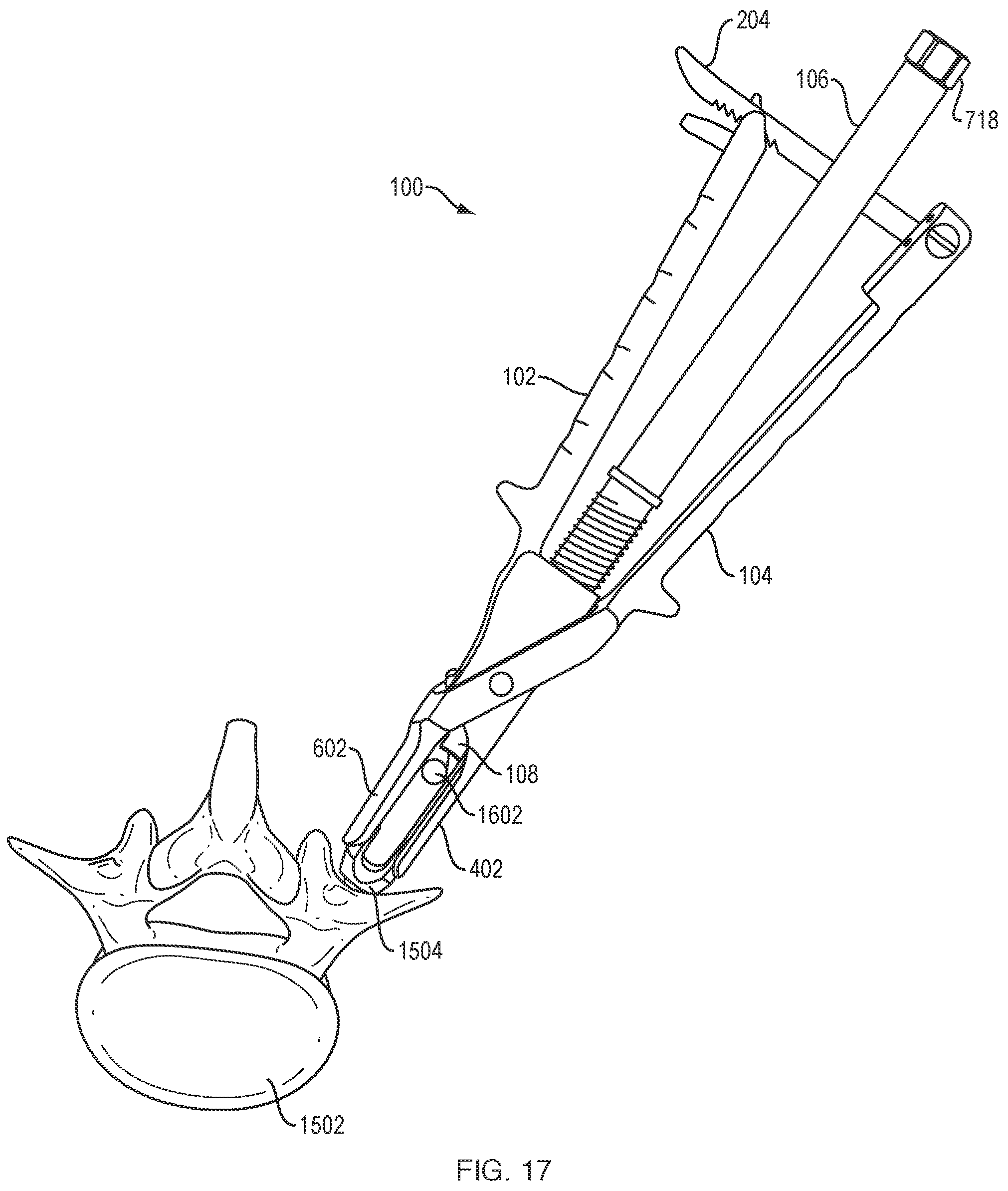 Patent US12318121 Figure 14 – Biplanar forceps reducers and methods of use