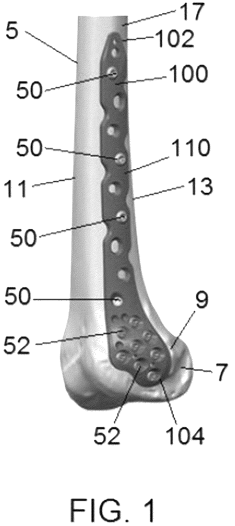 Patent US12318122 Figure 1 – Bone stabilization systems