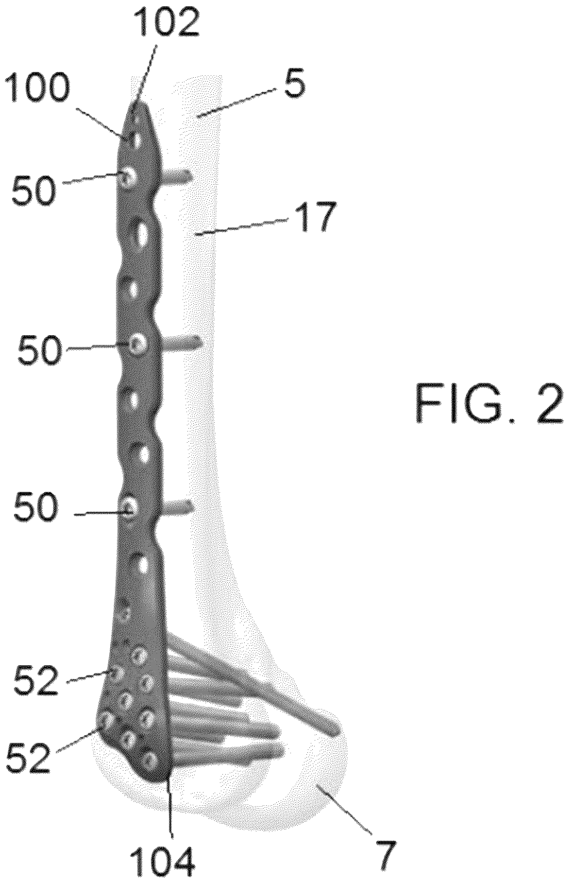 Patent US12318122 Figure 2 – Bone stabilization systems