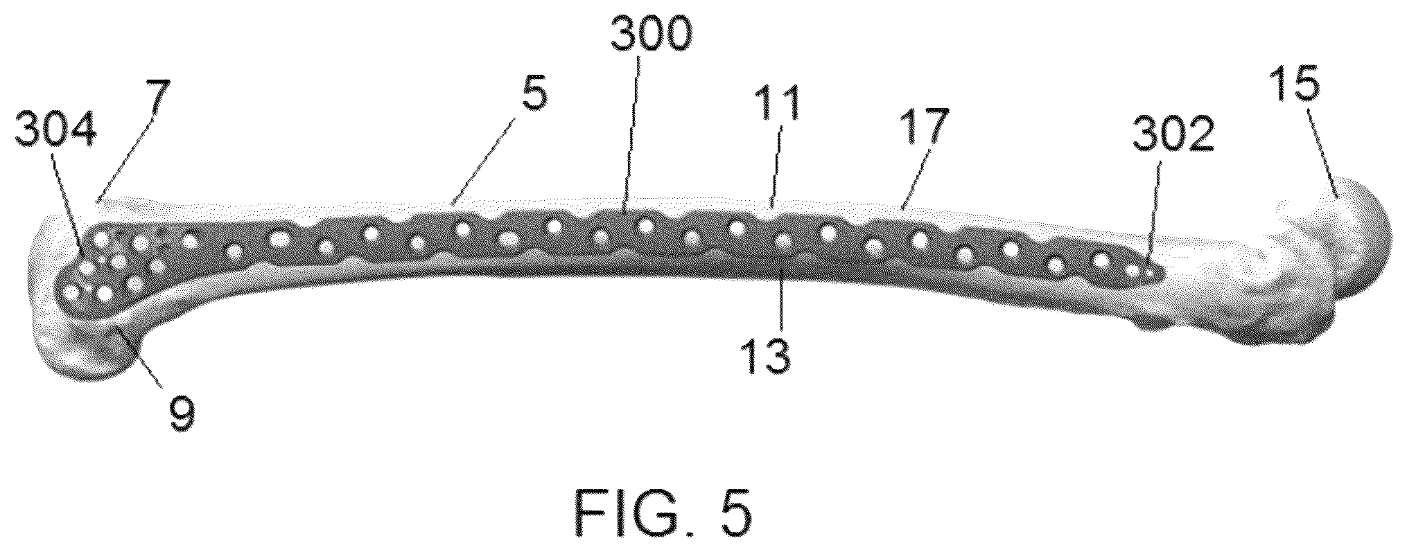 Patent US12318122 Figure 5 – Bone stabilization systems