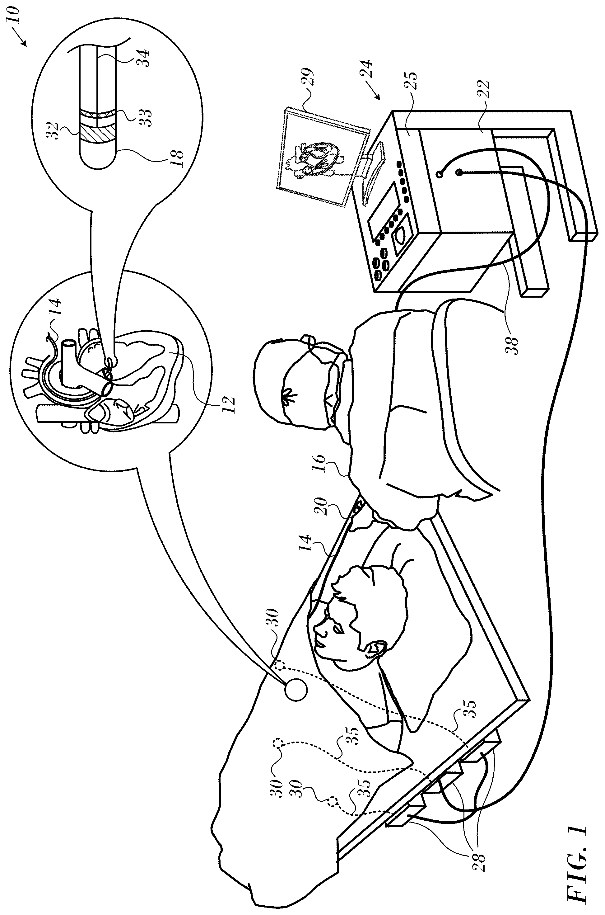 Patent US12318131 Figure 1 – Reduced size force sensor
