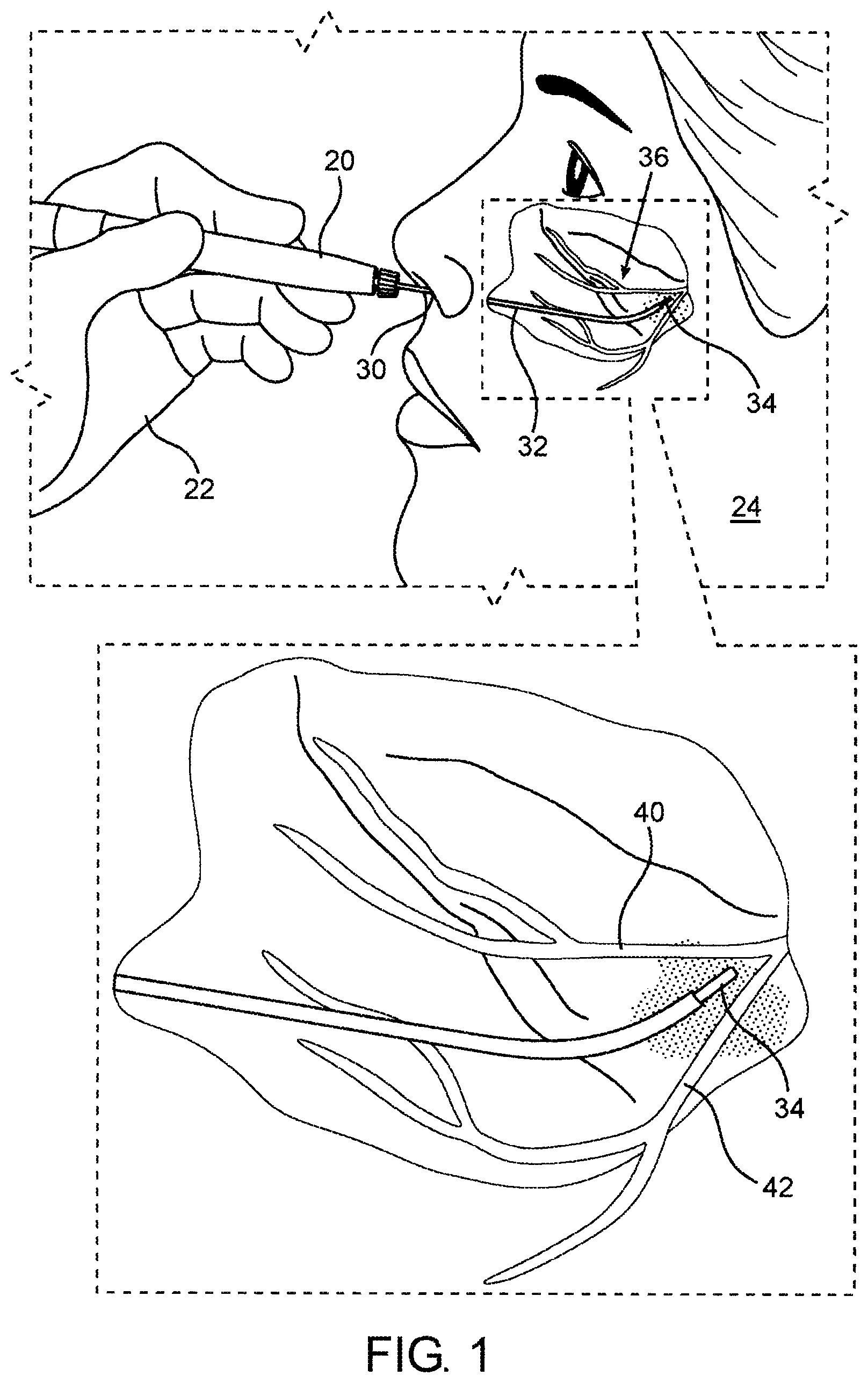 Patent US12318138 Figure 1 – Device and methods of laser treatment for rhinology