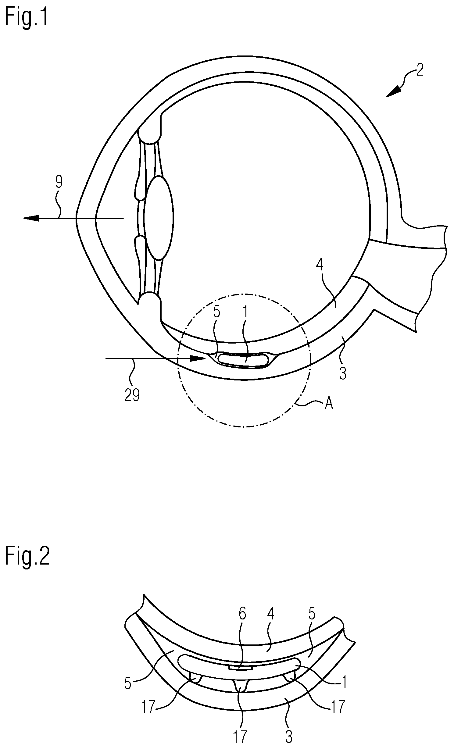 Patent US12318143 Figure 1 – Implant for determining intraocular pressure