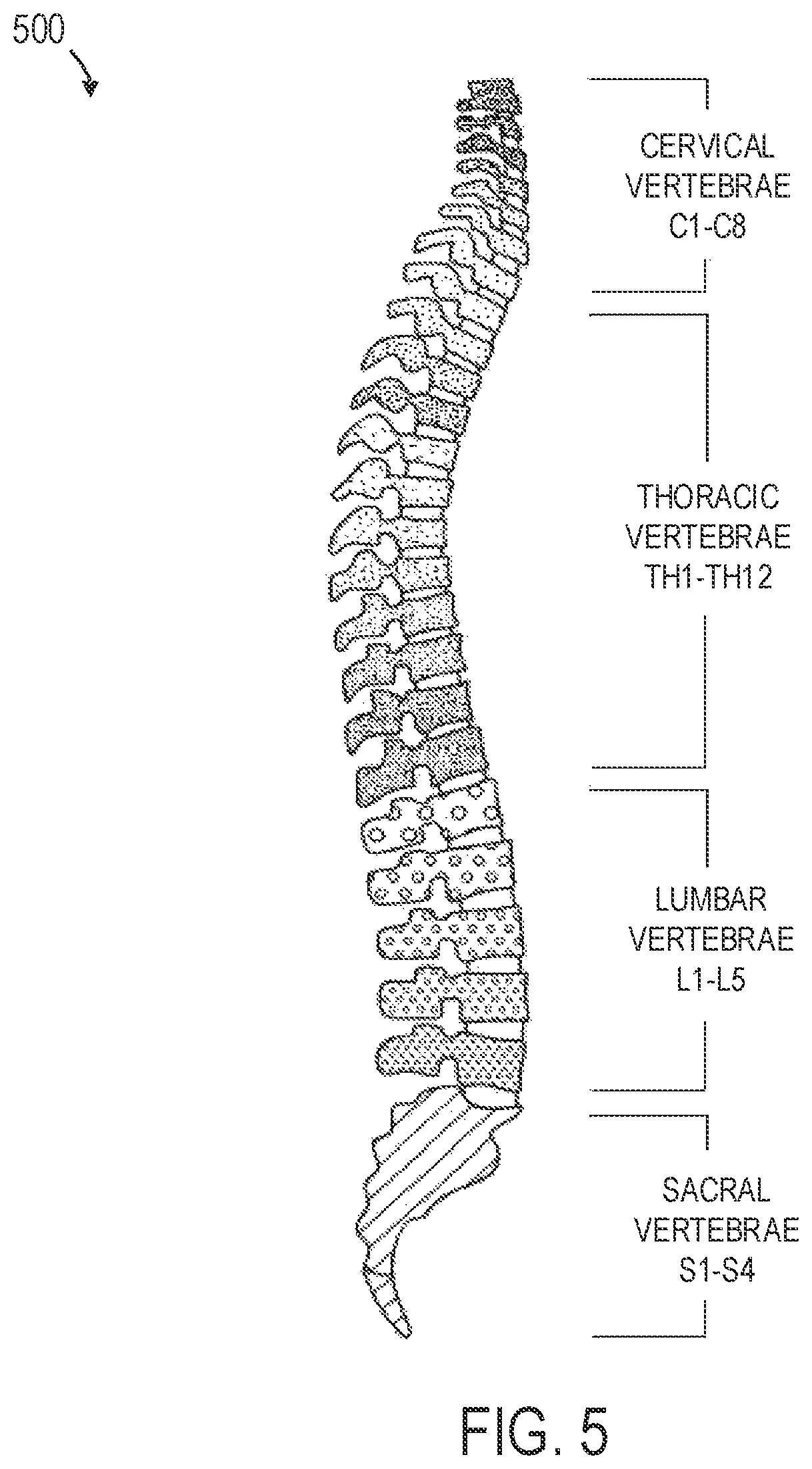 Patent US12318144 Figure 5 – Systems and methods for planning a patient-specific spinal correction